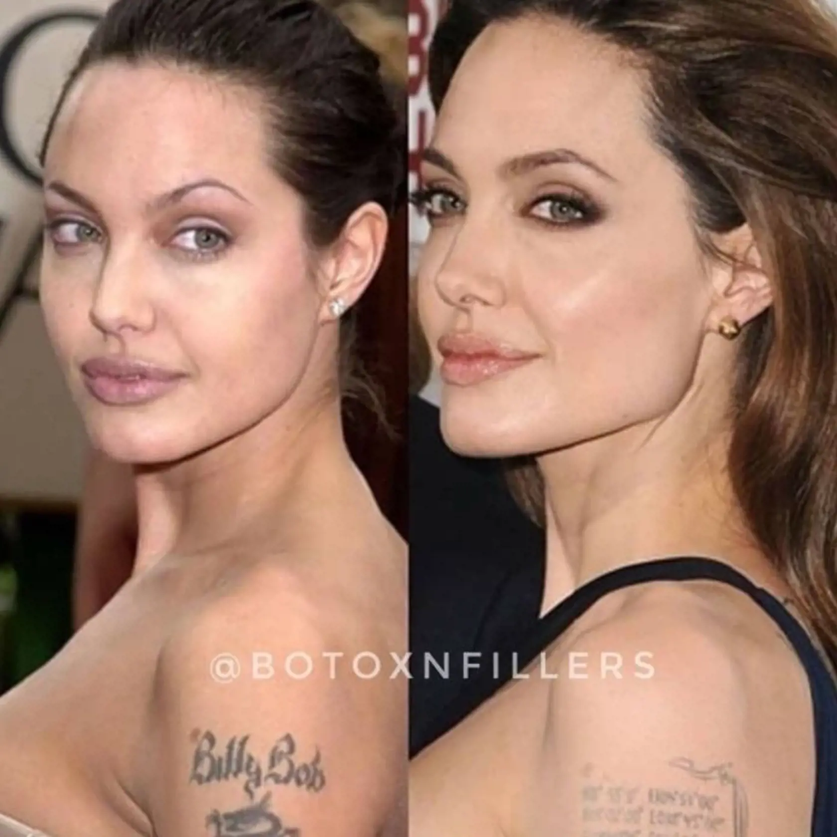 Angelina Jolie v roku 2000 a 2019. Na fotografii je vidieť, že jej tvar nosa sa výrazne zmenil. Taktiež má hranatejšiu tvár a výraznejšie lícne kosti.