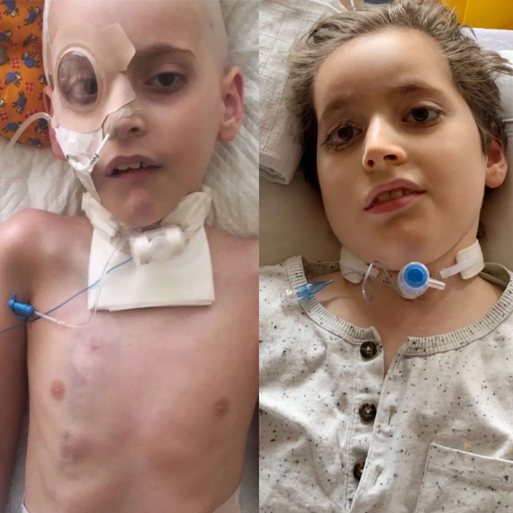 Alan Frešo má dnes 11 rokov a po chemoterapiách mu narástli už aj vlásky.