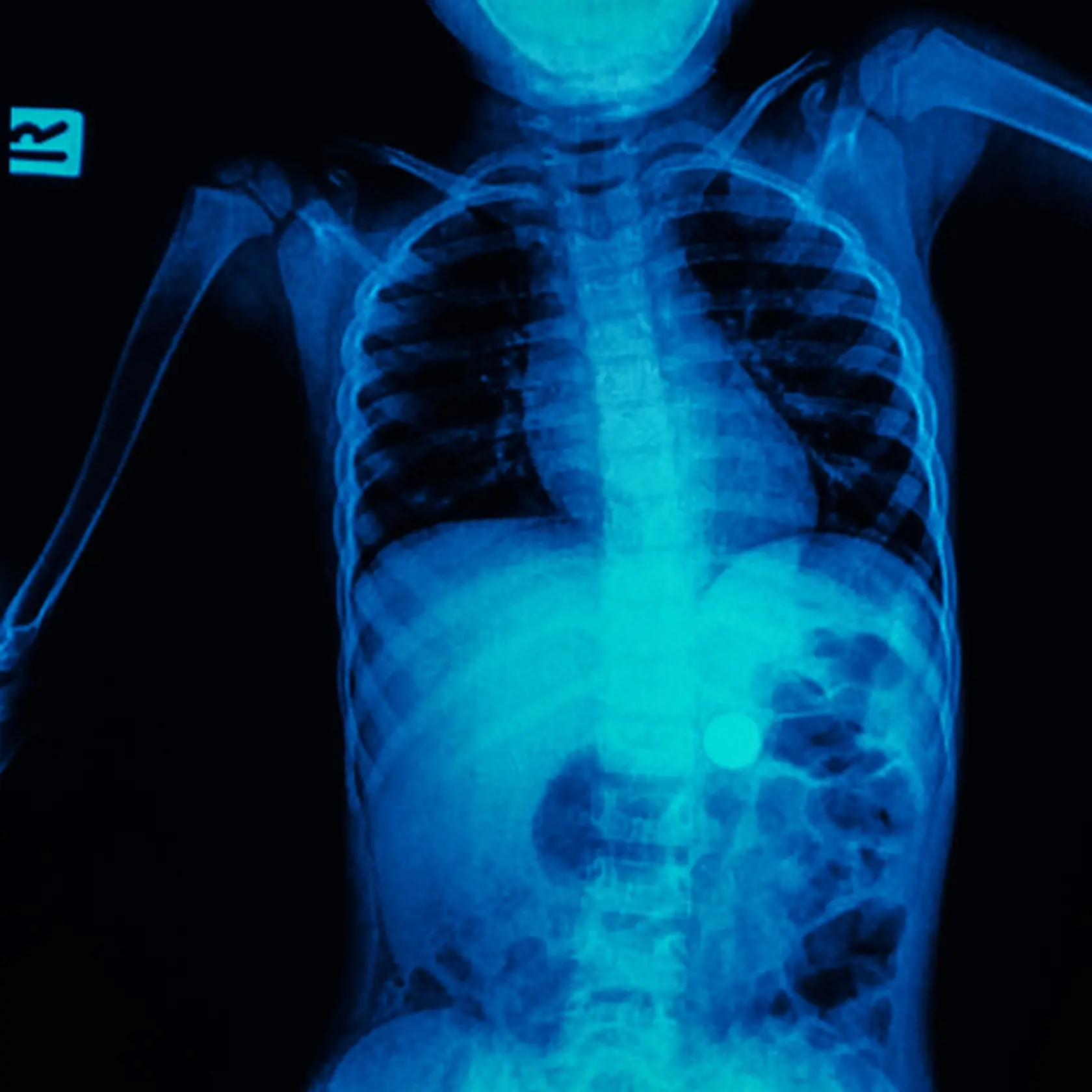 Aj keď zápal slepého čreva patrí medzi pomerne ľahko liečiteľné ochorenia, dôležitá je pri ňom včasná diagnostika. 