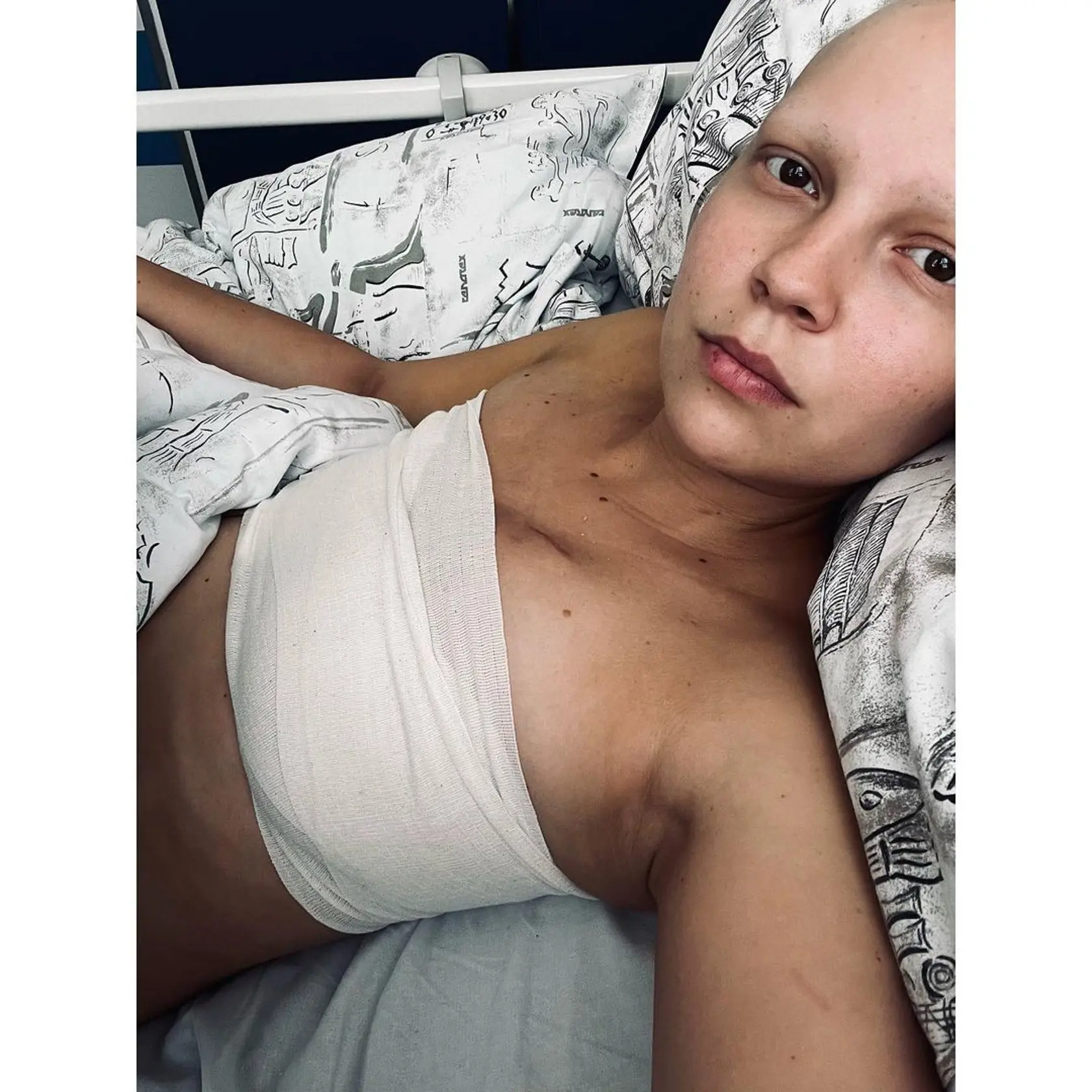 Patrícia Janečková po mastektómii.