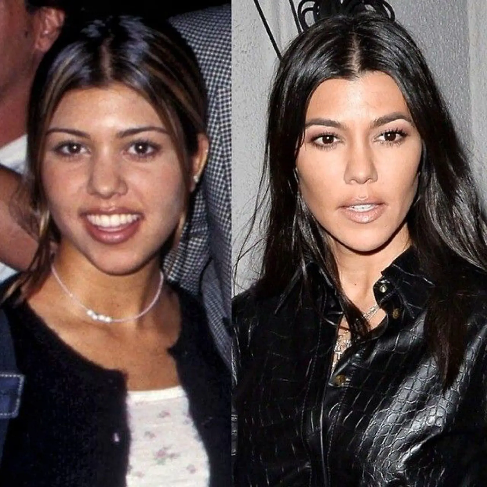 Kourtney Kardashian pred a po plastikách.