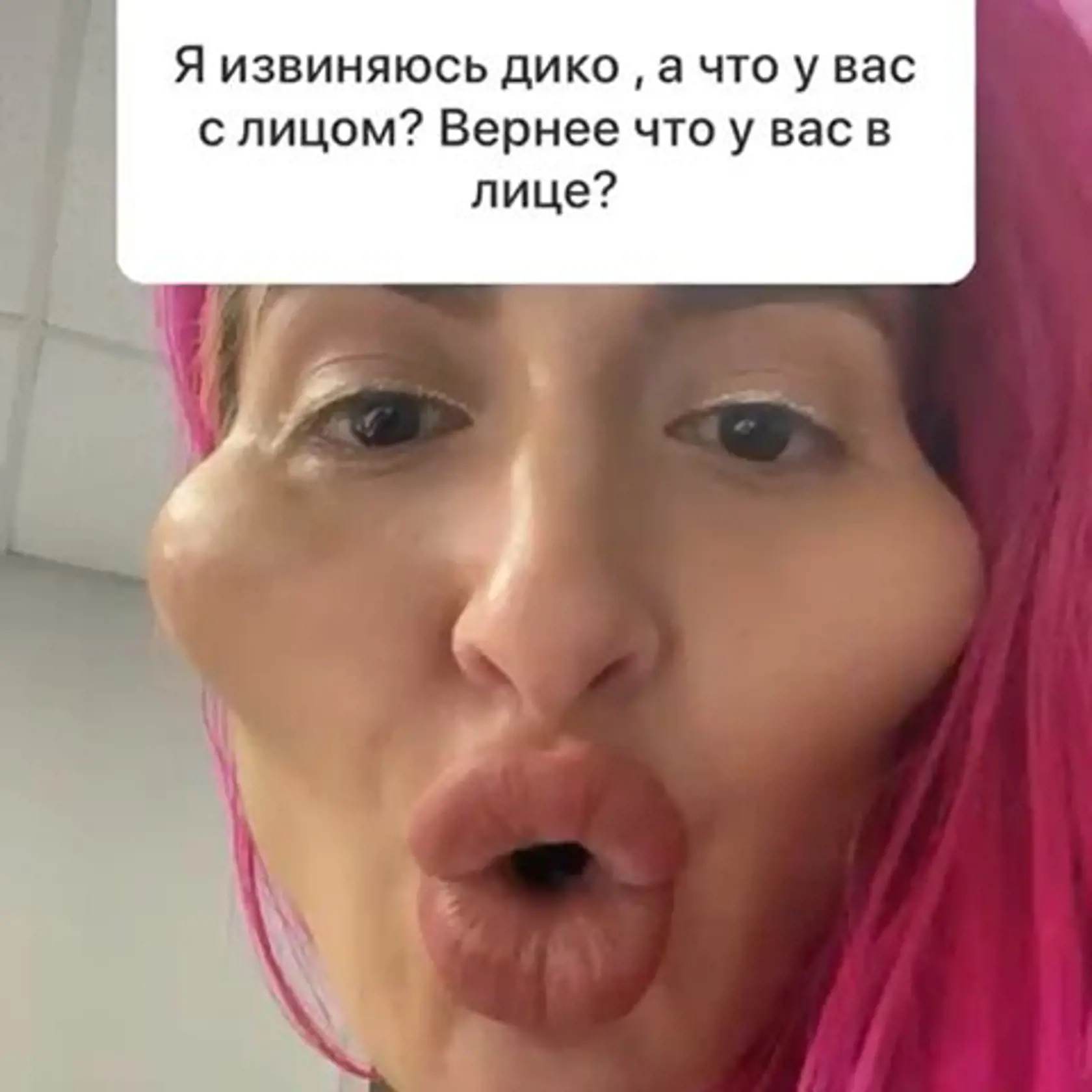 Anastasiia je Instagramová modelka, ktorá sa preslávila svojimi podivnými videami, v ktorých si vpichuje kyselinu hyalurónovú do pier a líc. Jej tvár má už od prirodzenosti poriadne ďaleko. Mnohým skôr však, ako krásnu ženu pripomína extrémnu karikatúru postavičky Jess Rabbit z animovaného filmu.