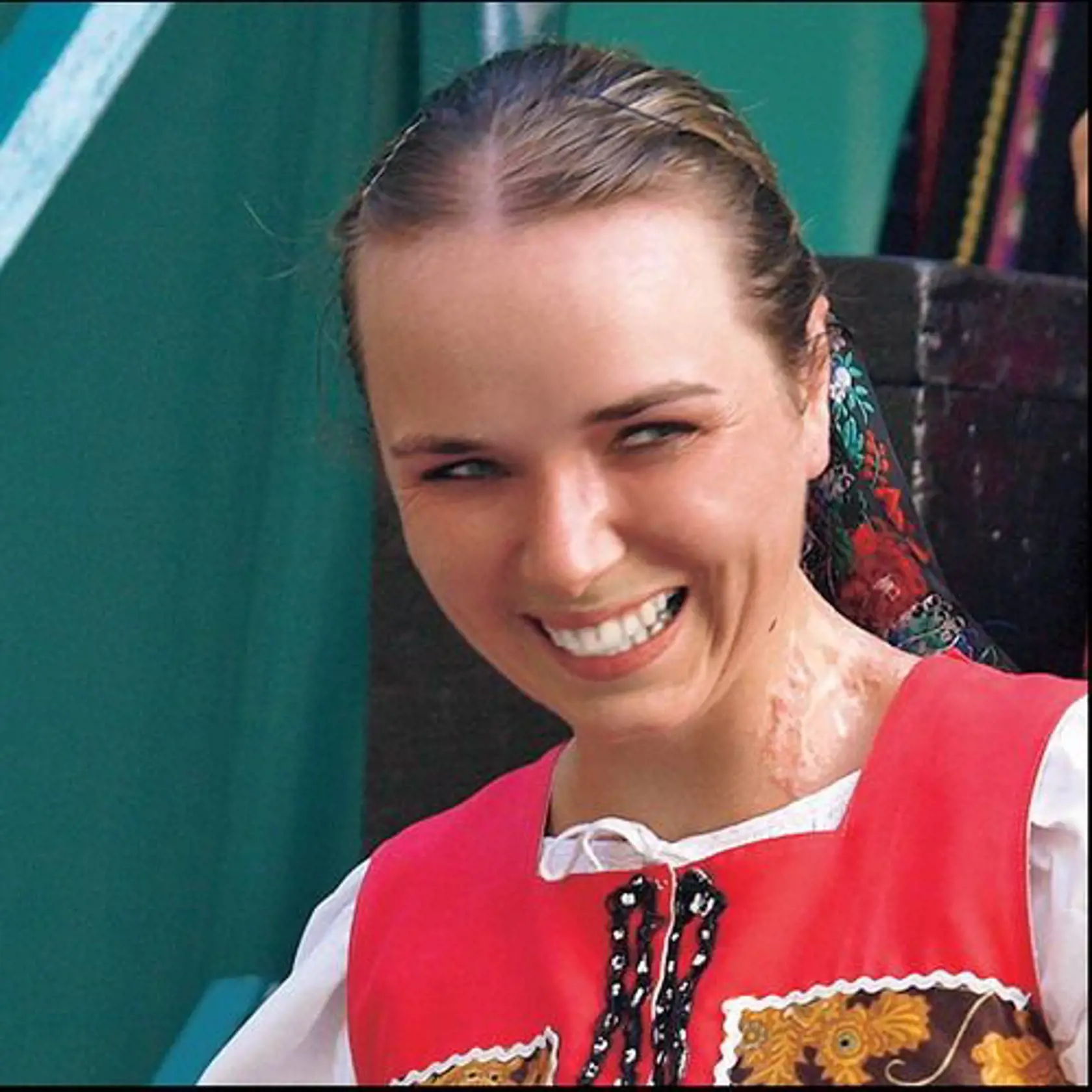 JANA VRŤOVÁ a jej jazvy na krku po nehode.