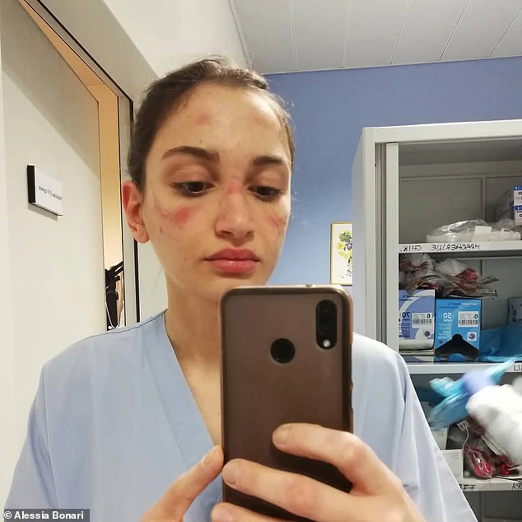 Talianska zdravotná sestra Alessia Bonari zverejnila fotografiu svojej tváre pomliaždenej od nosenia ochranných rúšok.