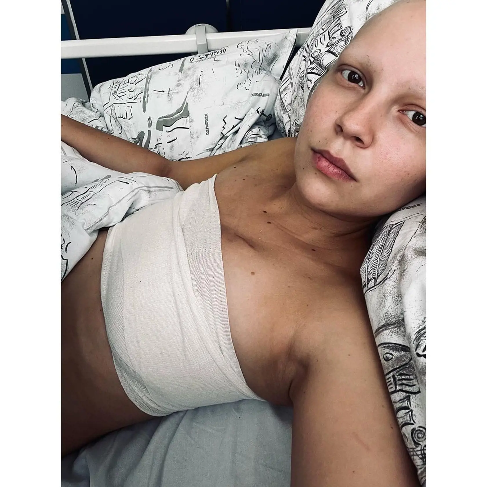 Patrícia Janečková po mastektómii.
