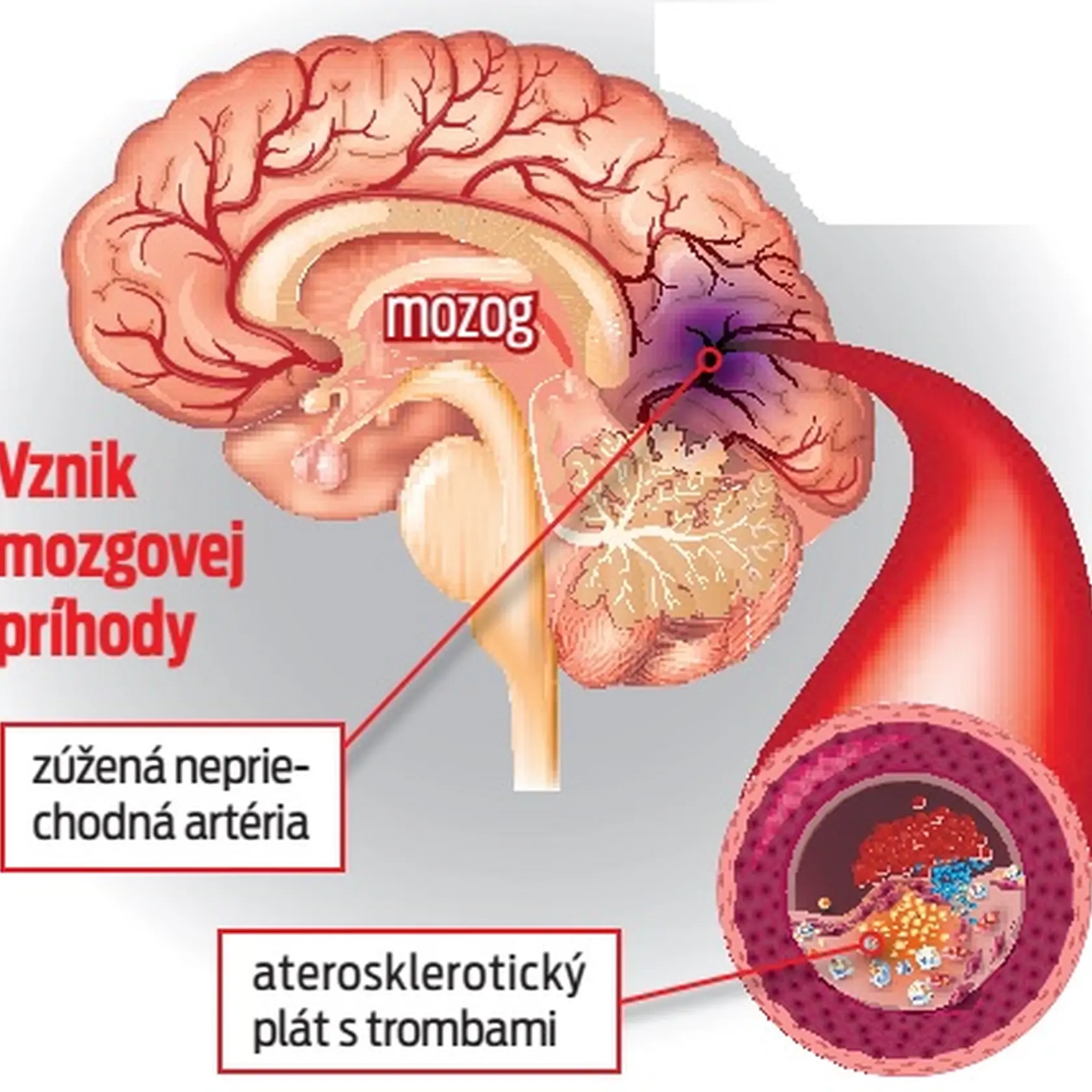 Vznik mozgovej príhody.