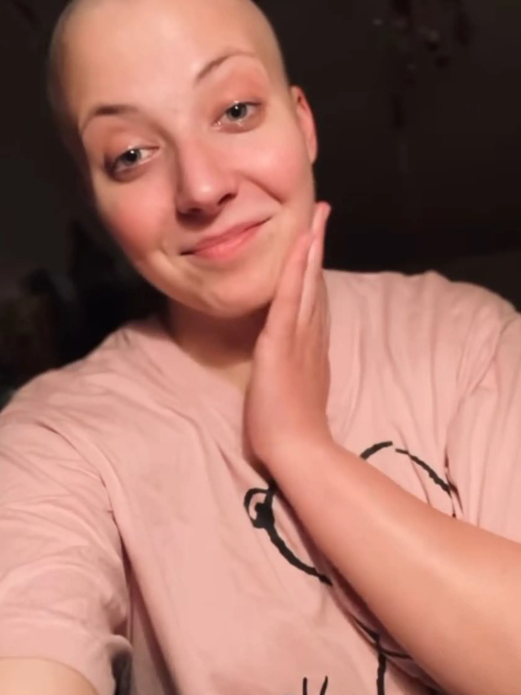 Anna Slováčková opäť prišla o vlasy. 