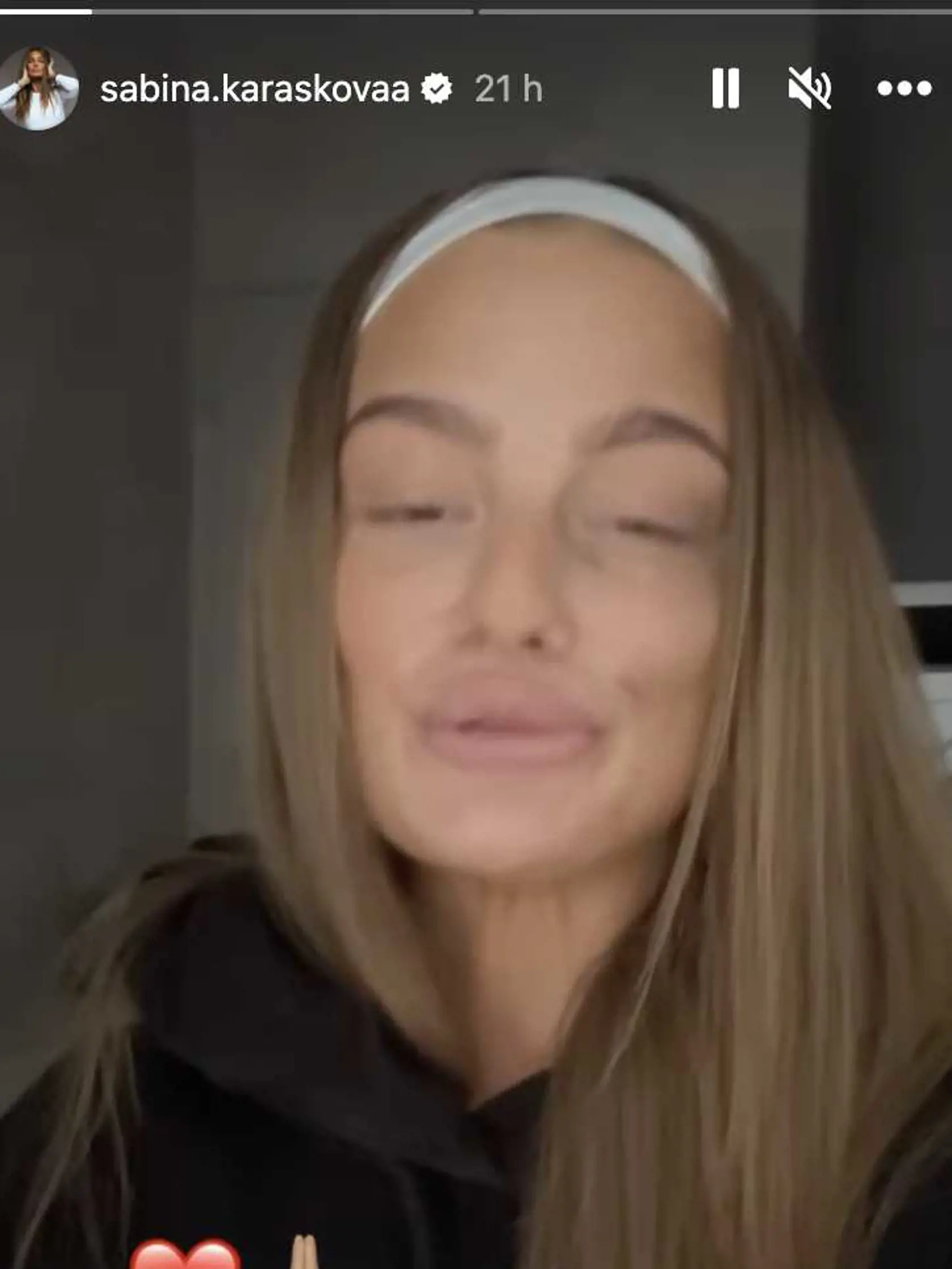 Sabina sa ukázala s modrinami na tvári