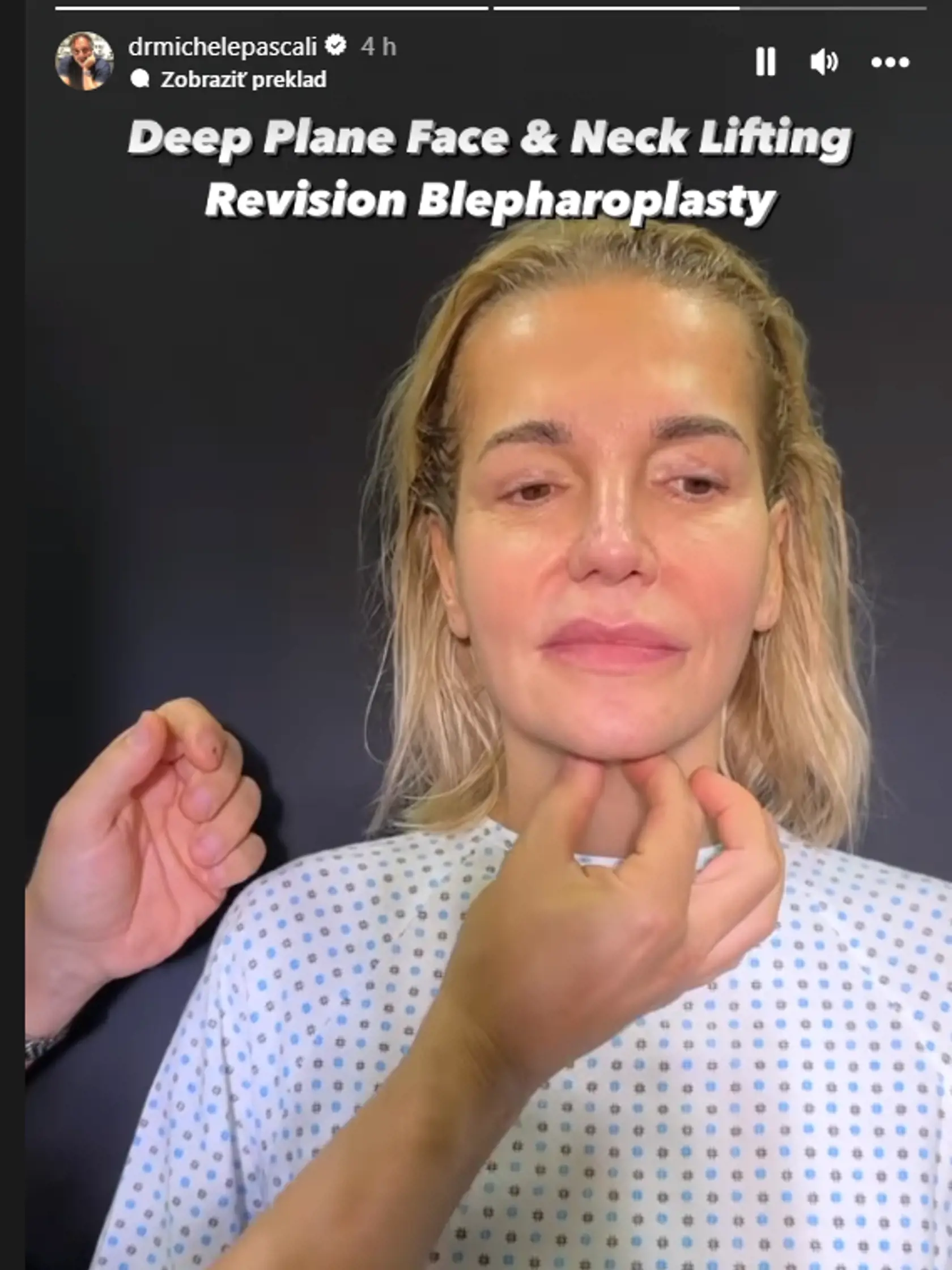 Dara Rolins u plastického chirurga v Taliansku. Video so speváčkou zverejnil samotný doktor.