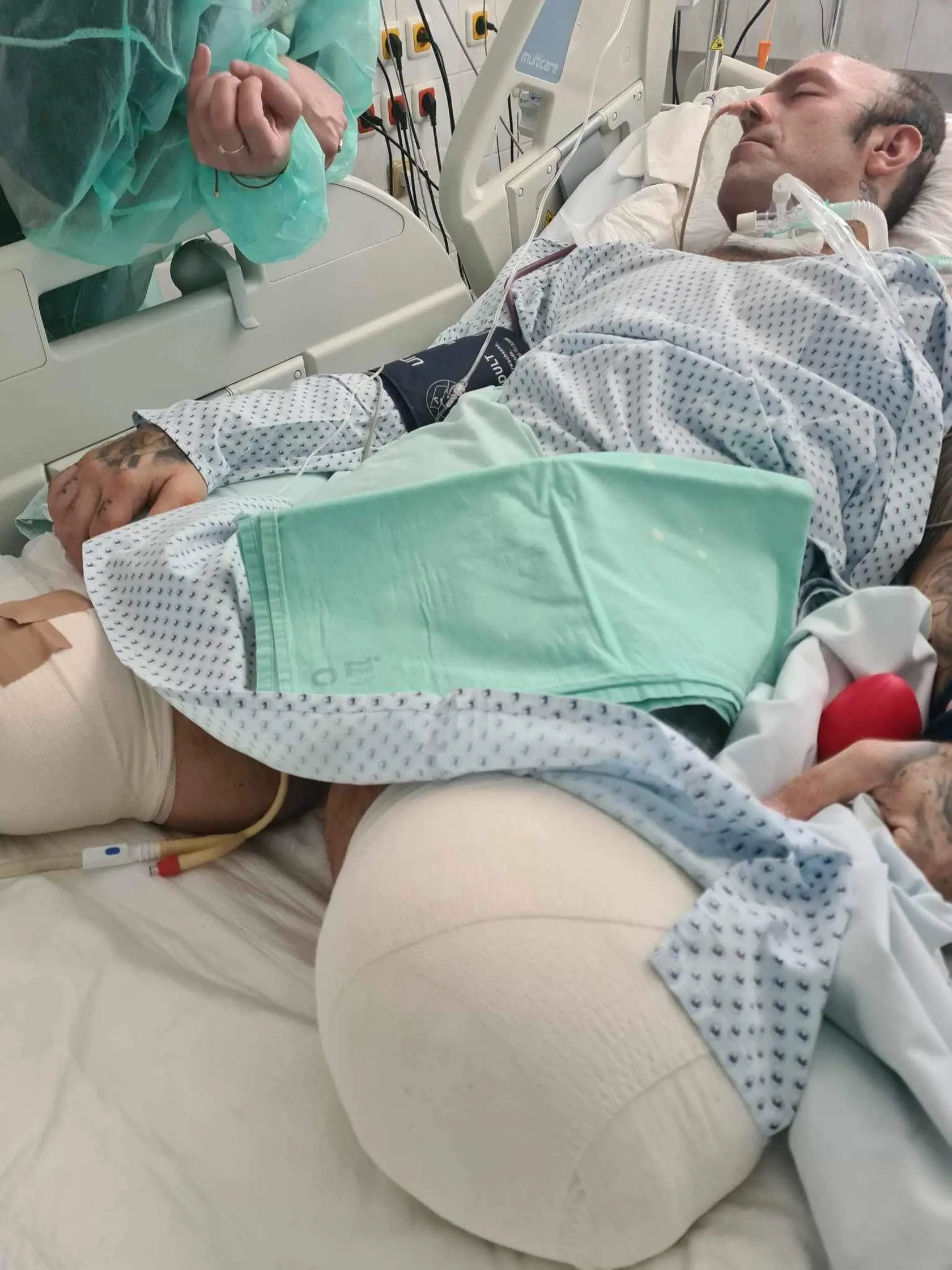 Zrazenina sa však začala uvoľňovať a upchala cievy v nohách. Obe dolné končatiny mu museli lekári amputovať - najprv pod kolenami, neskôr rezali v polovici stehien.