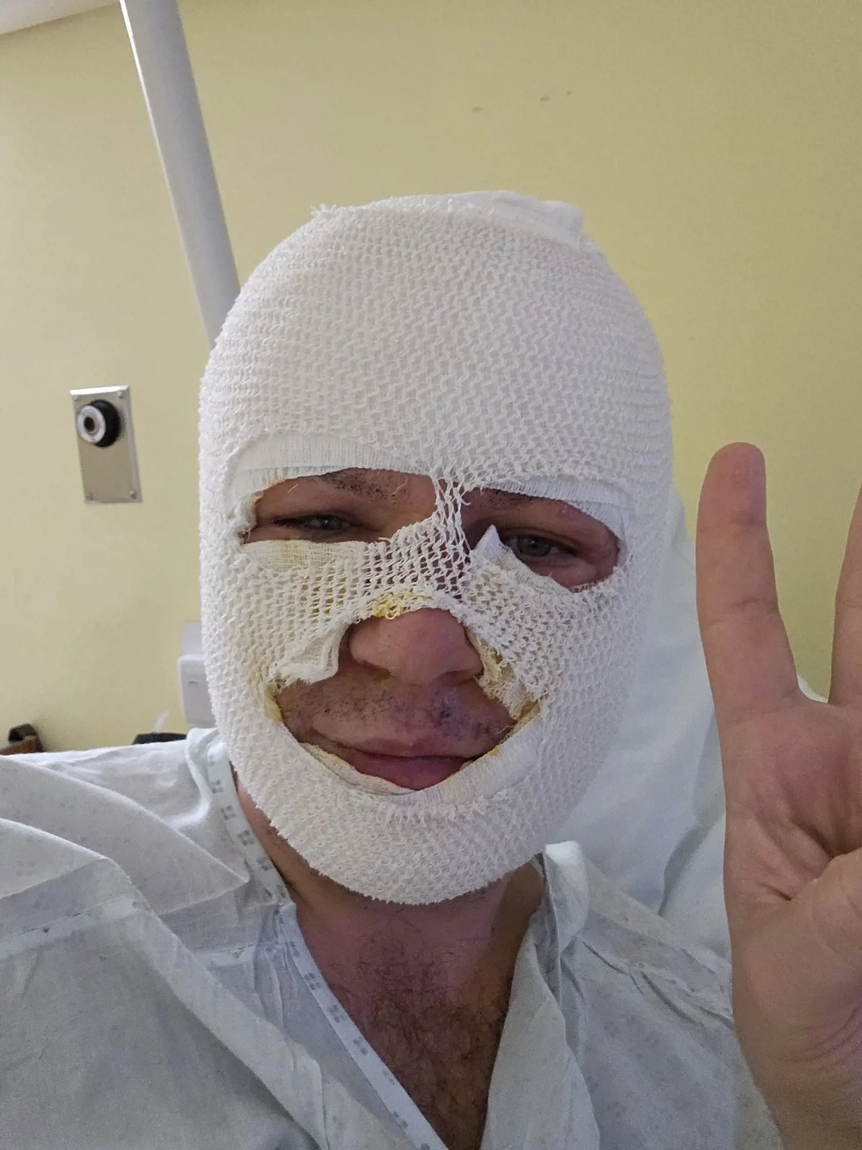Miroslav Žiak si pri zapalovaní biokrbu spôsobil popáleniny.