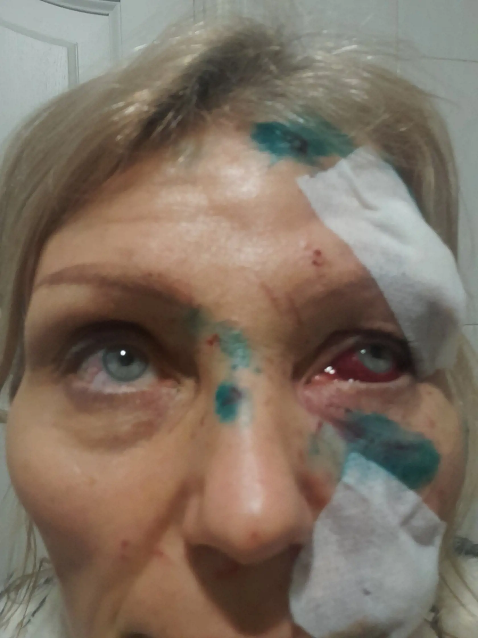 Olena Kurilo sa zotavuje zo zranení. Rusko tvrdí, že je to nasadená herečka.
