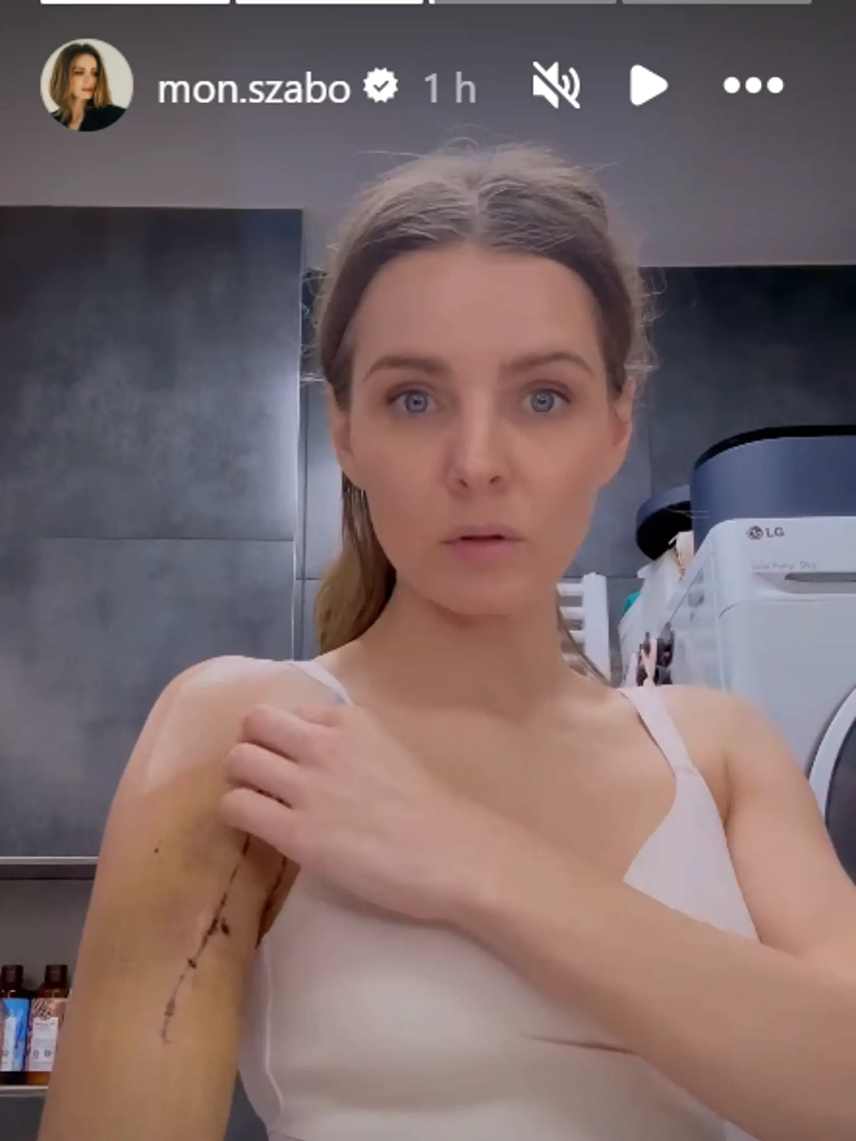 Herečka Monika Szabó ukázala, aká jazva jej po úraze na lyžiach ostala.