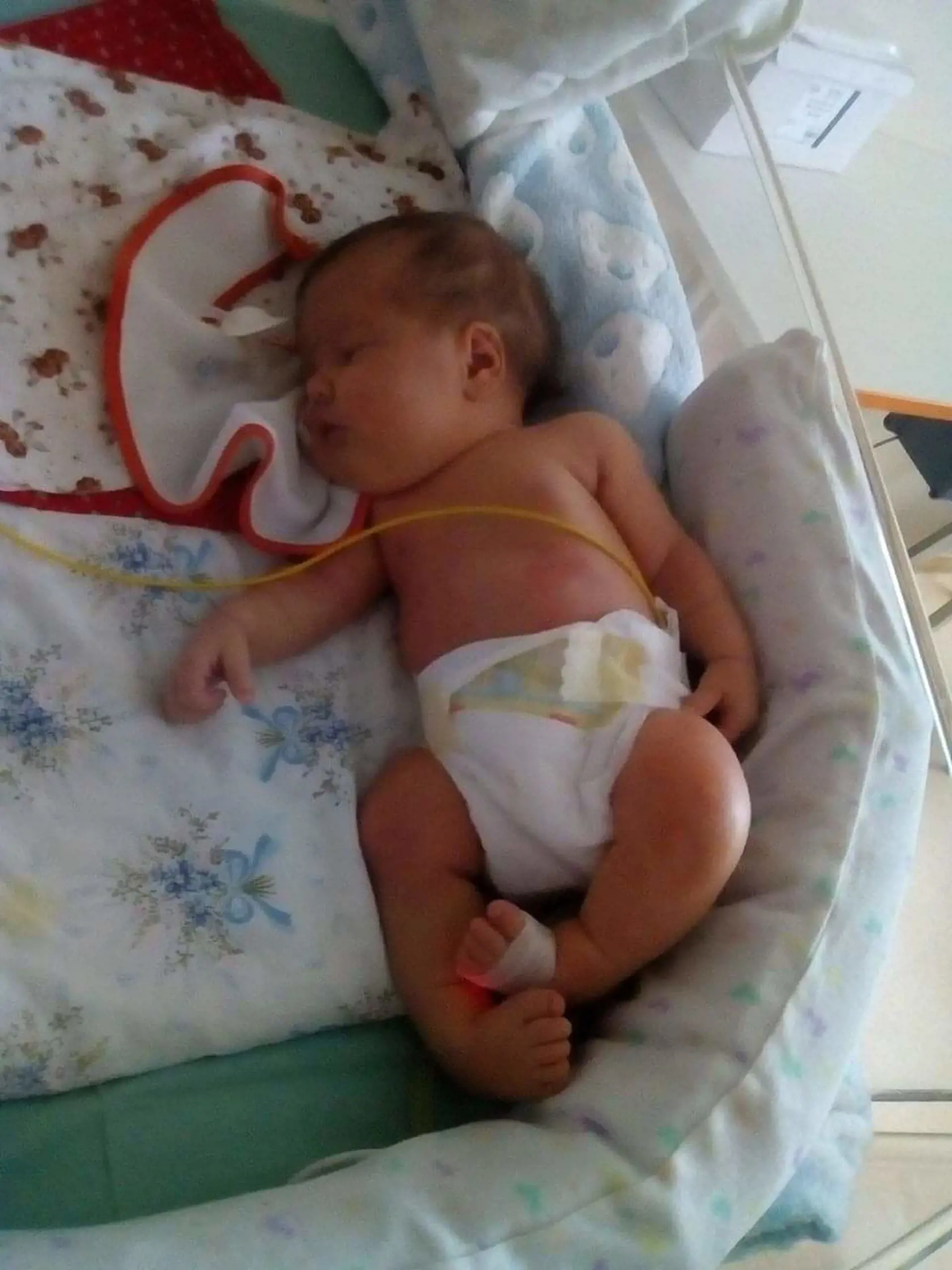 Sofia (4) sa narodila so štvorkomorovým hydrocefalom a rázštepom chrbtice.