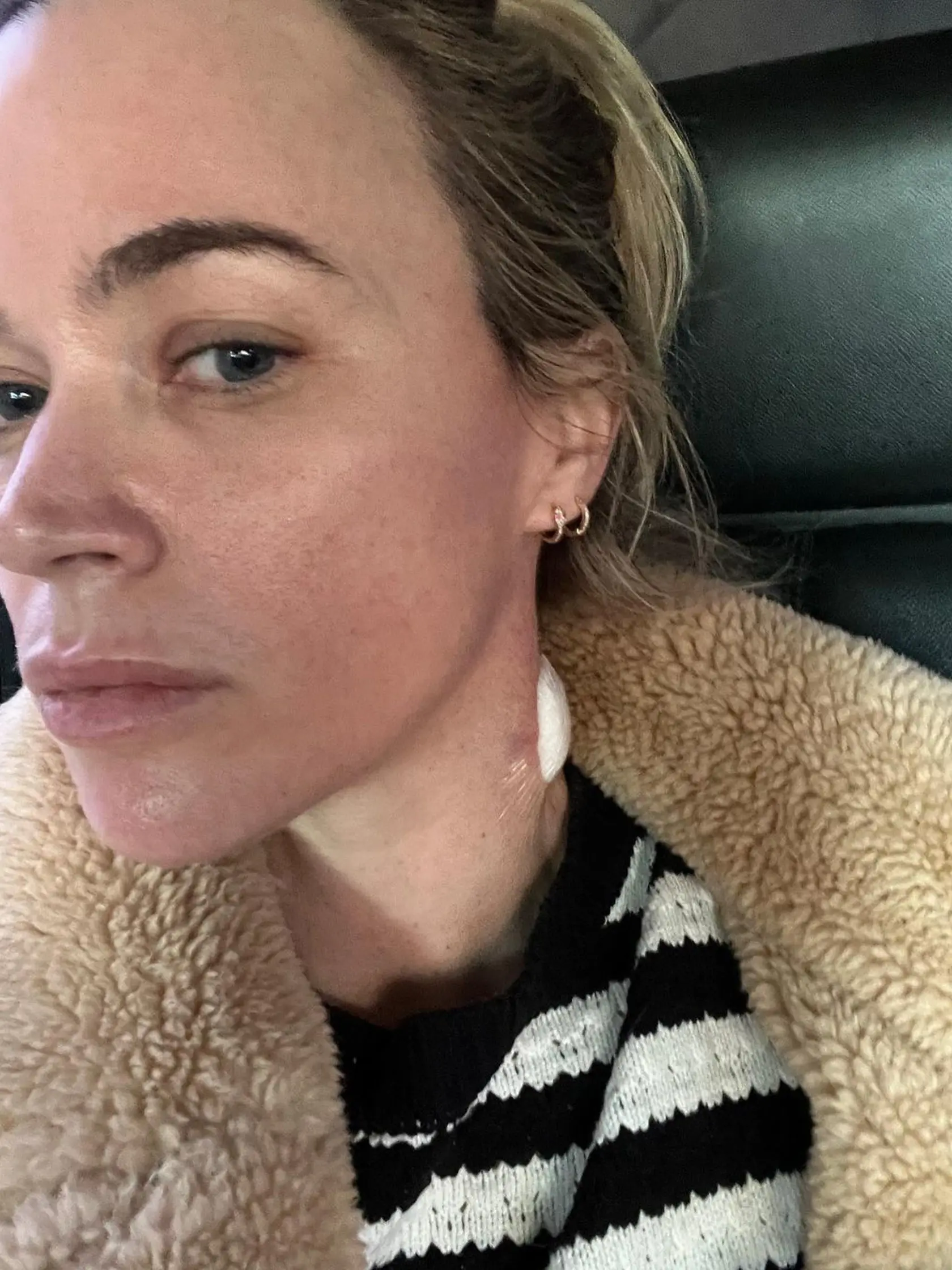Sympatická blondínka Teddi Mellencamp ukázala fanúšikom svoje jazvy aj hrčku na krku počas svojho boja s rakovinou kože.
