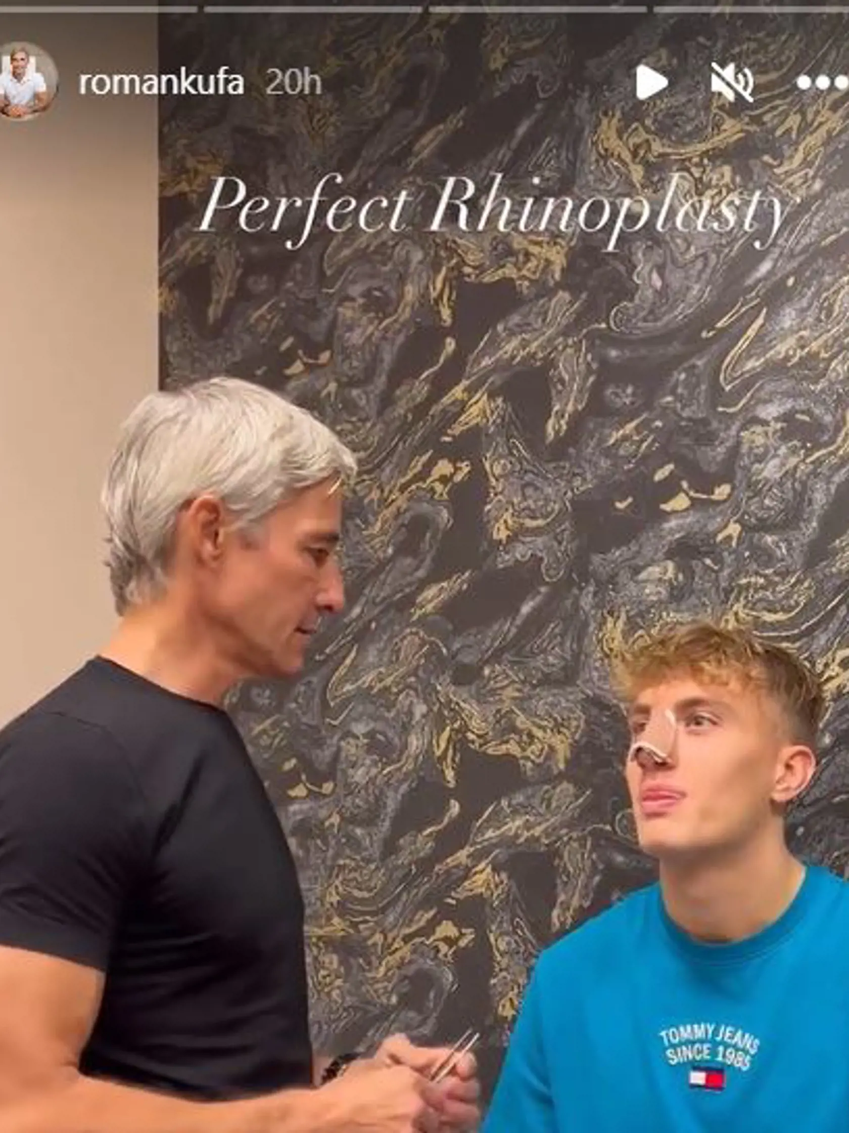 David z Love Island má za sebou rhinoplastiku.