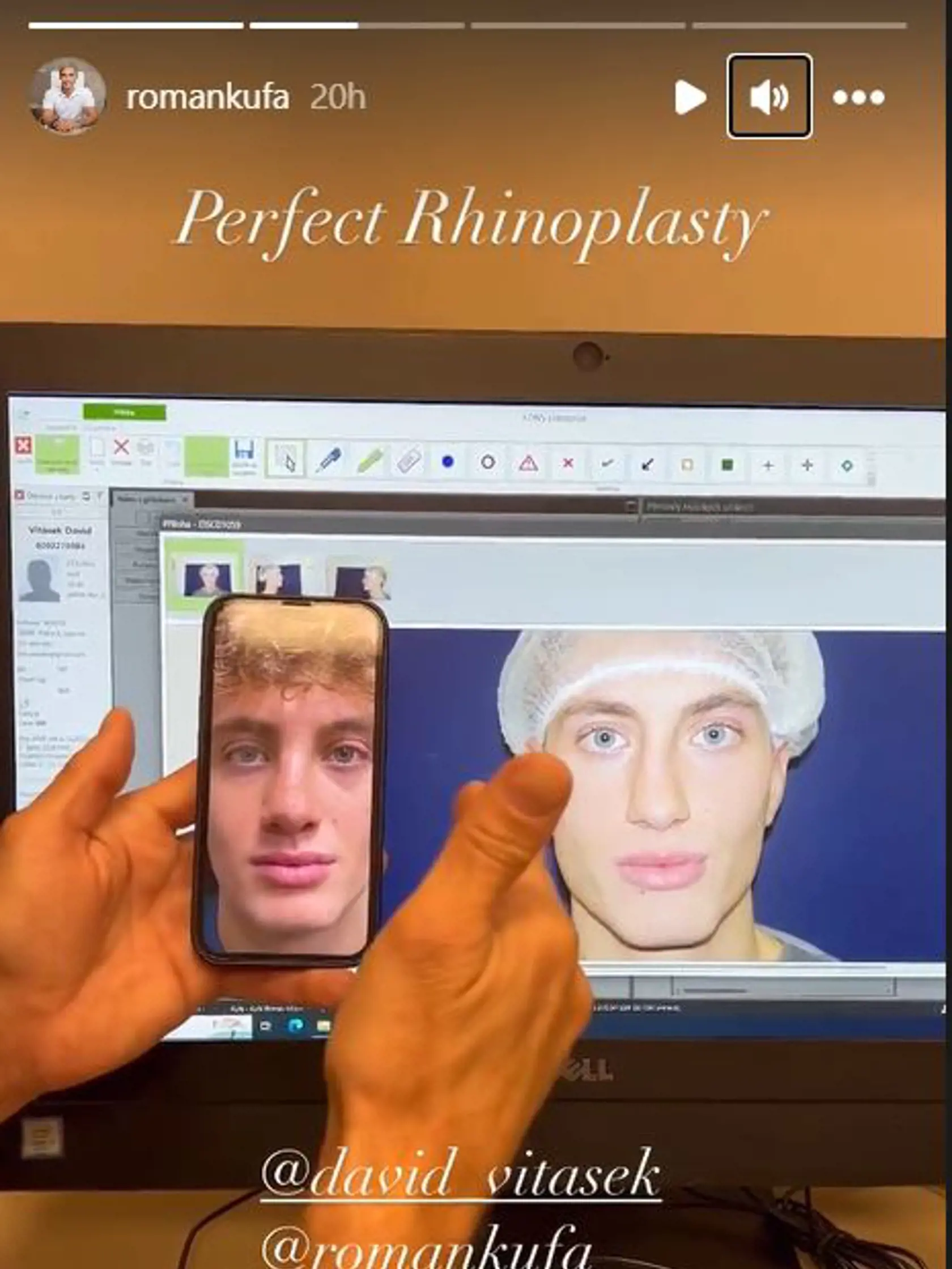 David z Love Island má za sebou rhinoplastiku. Takto vyzerá po zložení dlahy.