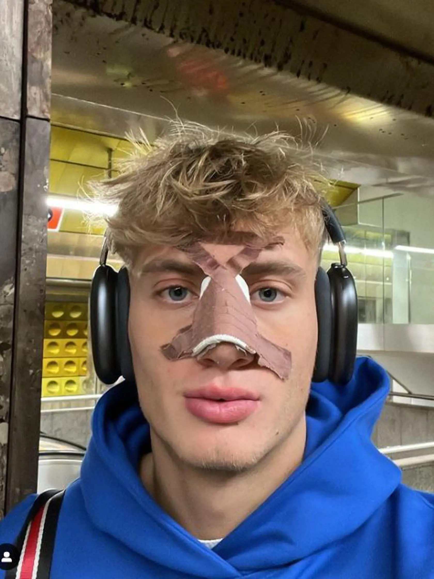 David z Love Island má za sebou rhinoplastiku.