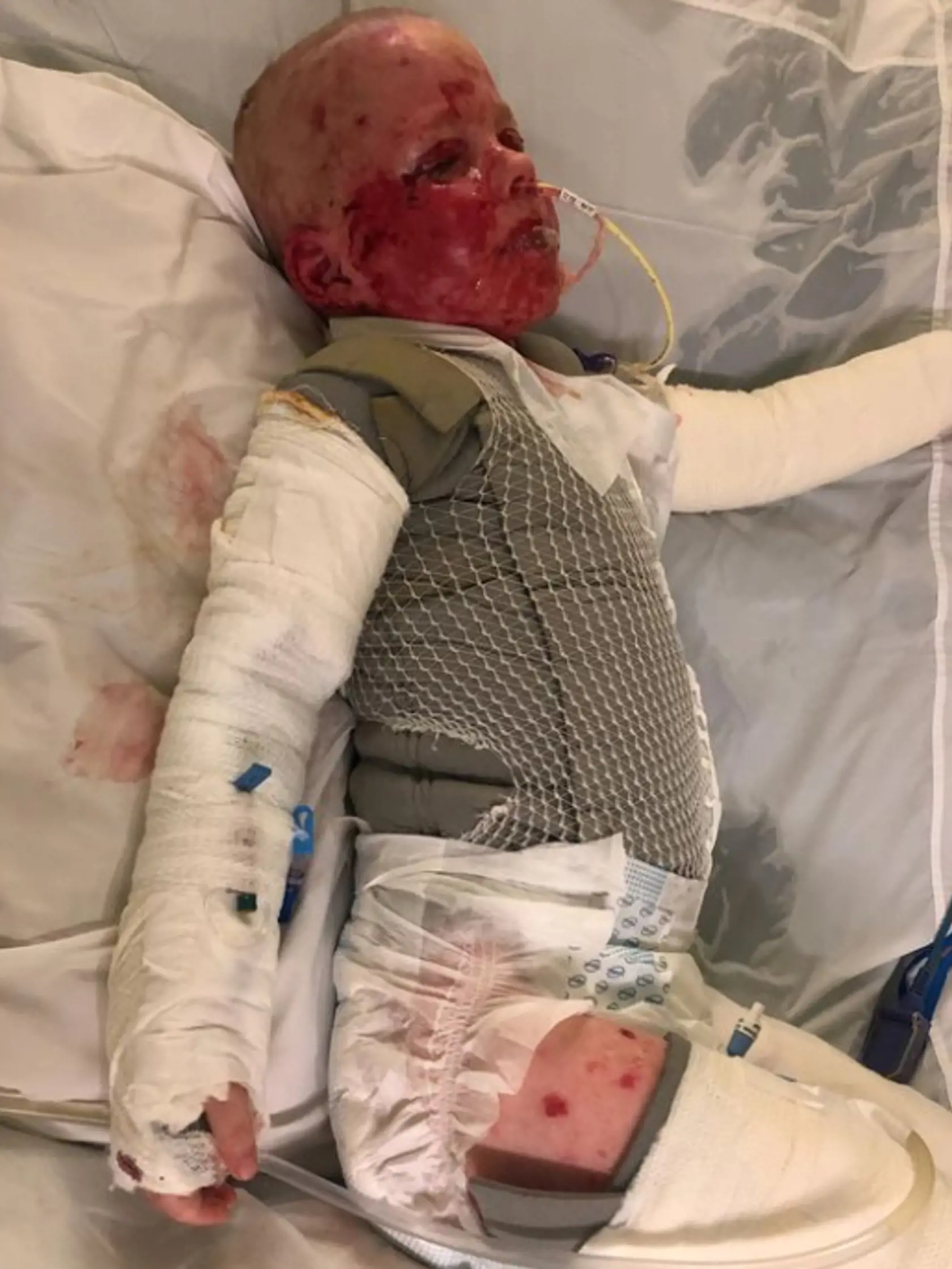 Chlapčeka okamžite hospitalizovali s vážnou a ojedinelou diagnózou Stevens-Johnsonov syndróm, ktorá sa prejavuje bolestivou vyrážkou, pľuzgiermi, popáleninami a poškodením slizníc.