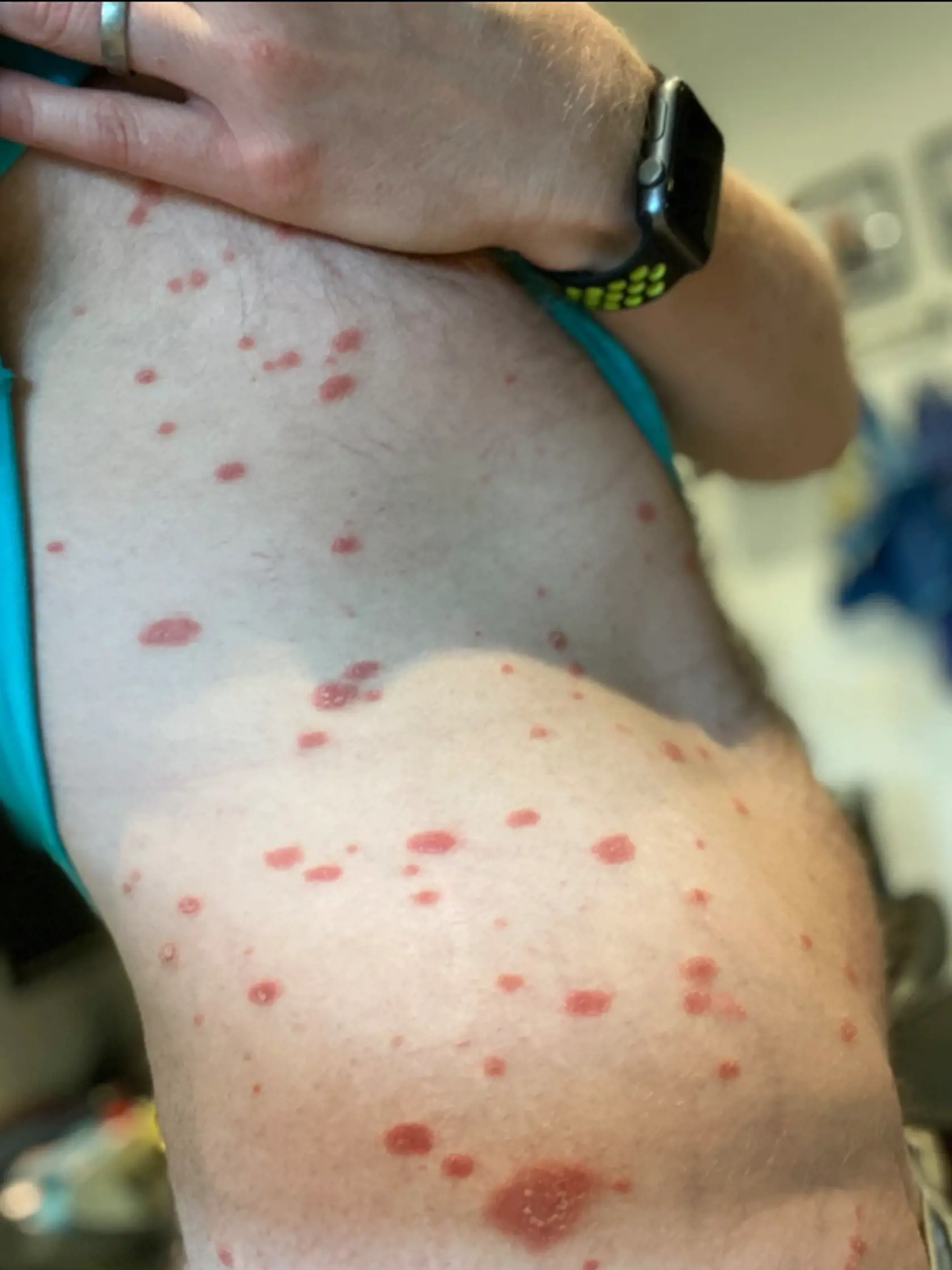 4. Pityriasis rosea (Heraldova škvrna) - je kožné ochorenie charakterizované tvorbou červenej ekzematóznej škvrny väčšinou okrúhleho tvaru, neskôr výsevom vyrážok po celom tele. Vyskytuje sa najmä na hrudníku a na chrbte. Pri tomto kožnom ochorení je časté svrbenie a pocit nepohodlia.