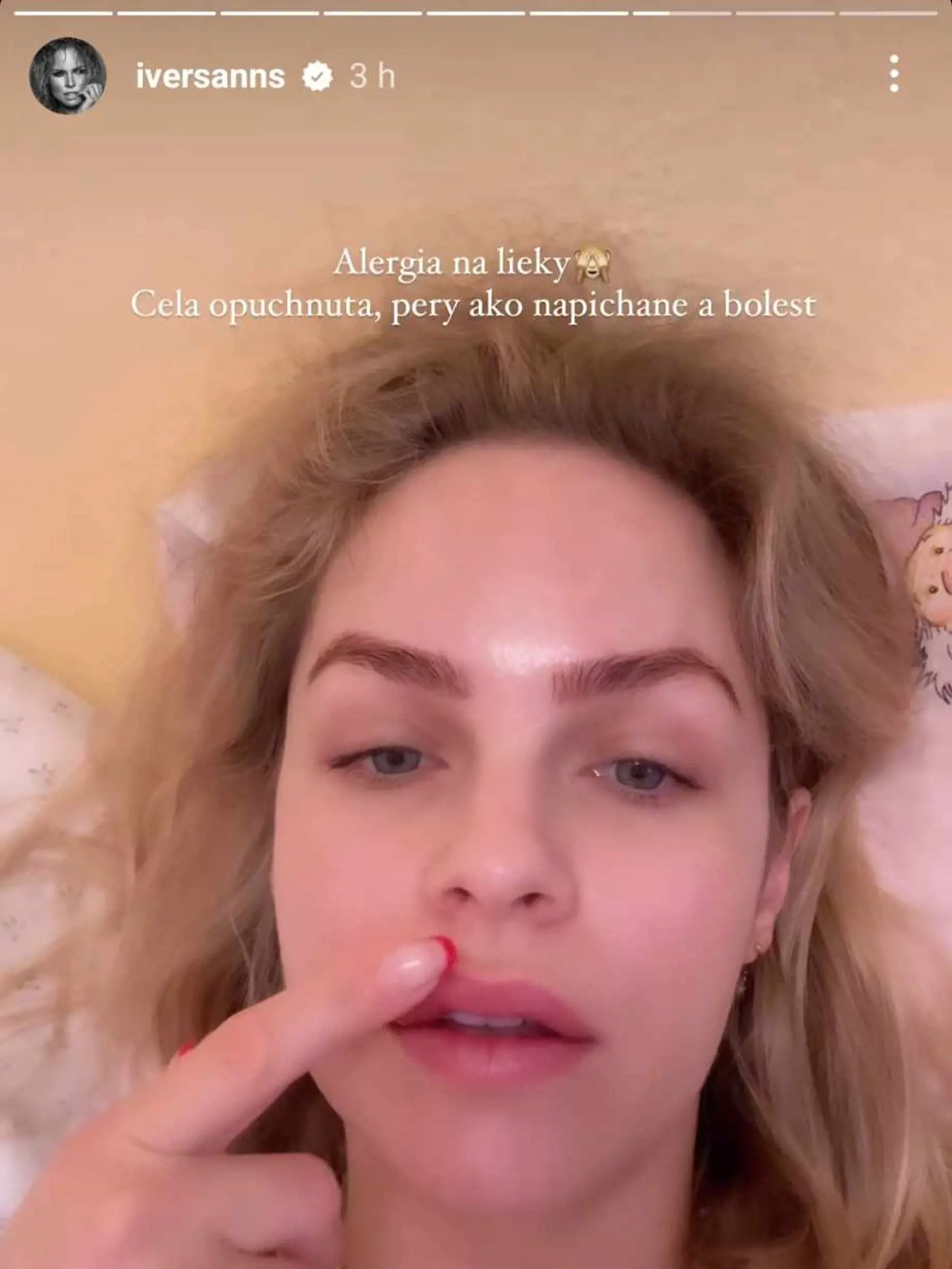 Ivana ukázala opuchnuté pery.