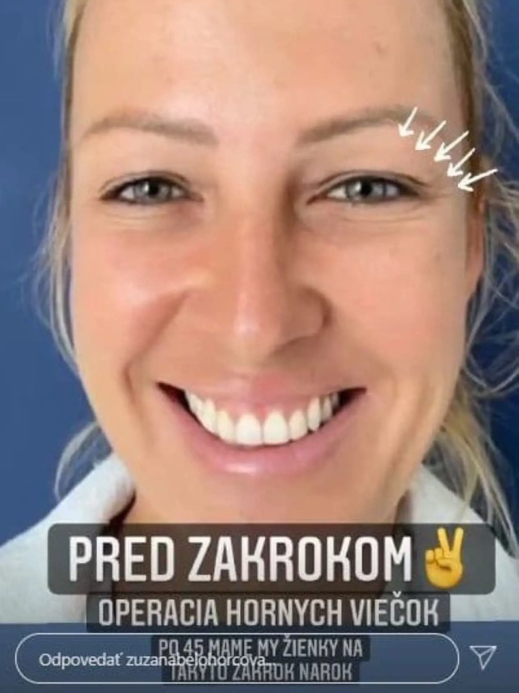 Zuzana Belohorová pred operáciou viečok.