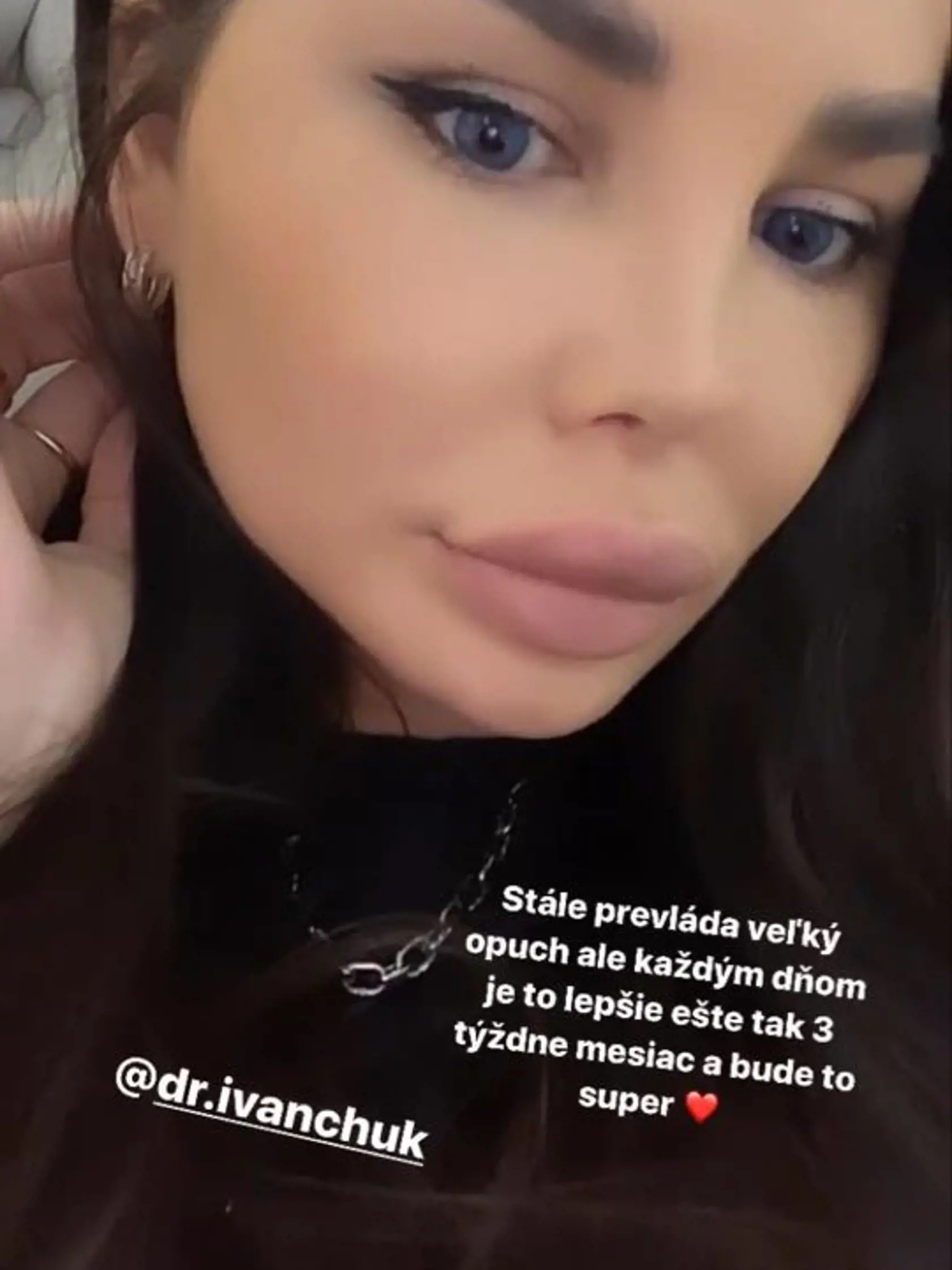 Plačková zverejnila prvé foto po plastickej operácii tváre. Zo Zuzany je úplne iný človek.