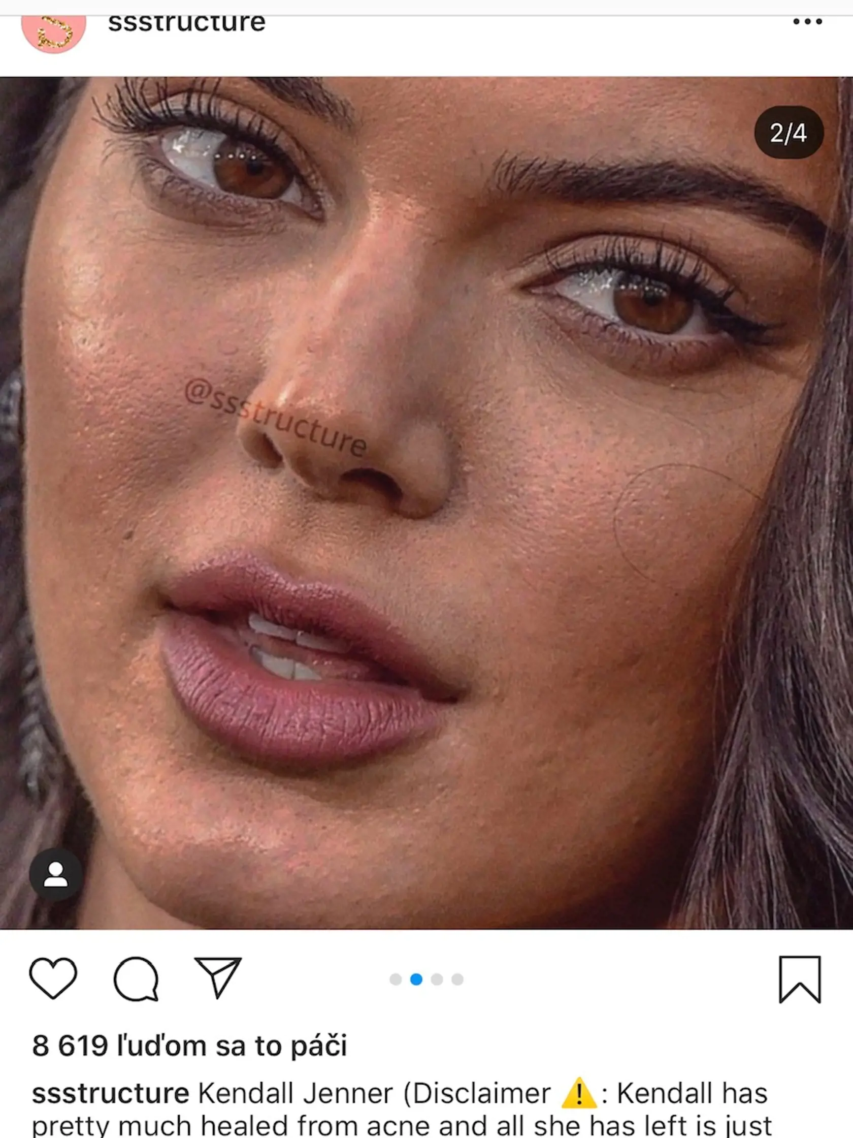 Kendall Jenner nemá dvakrát hladkú pleť.