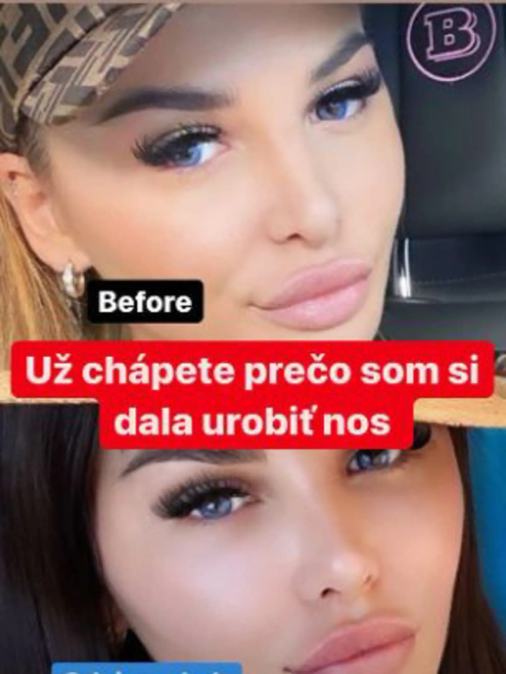 Plačková zverejnila fotku, na ktorej ukazuje, prečo si dala urobiť nos.