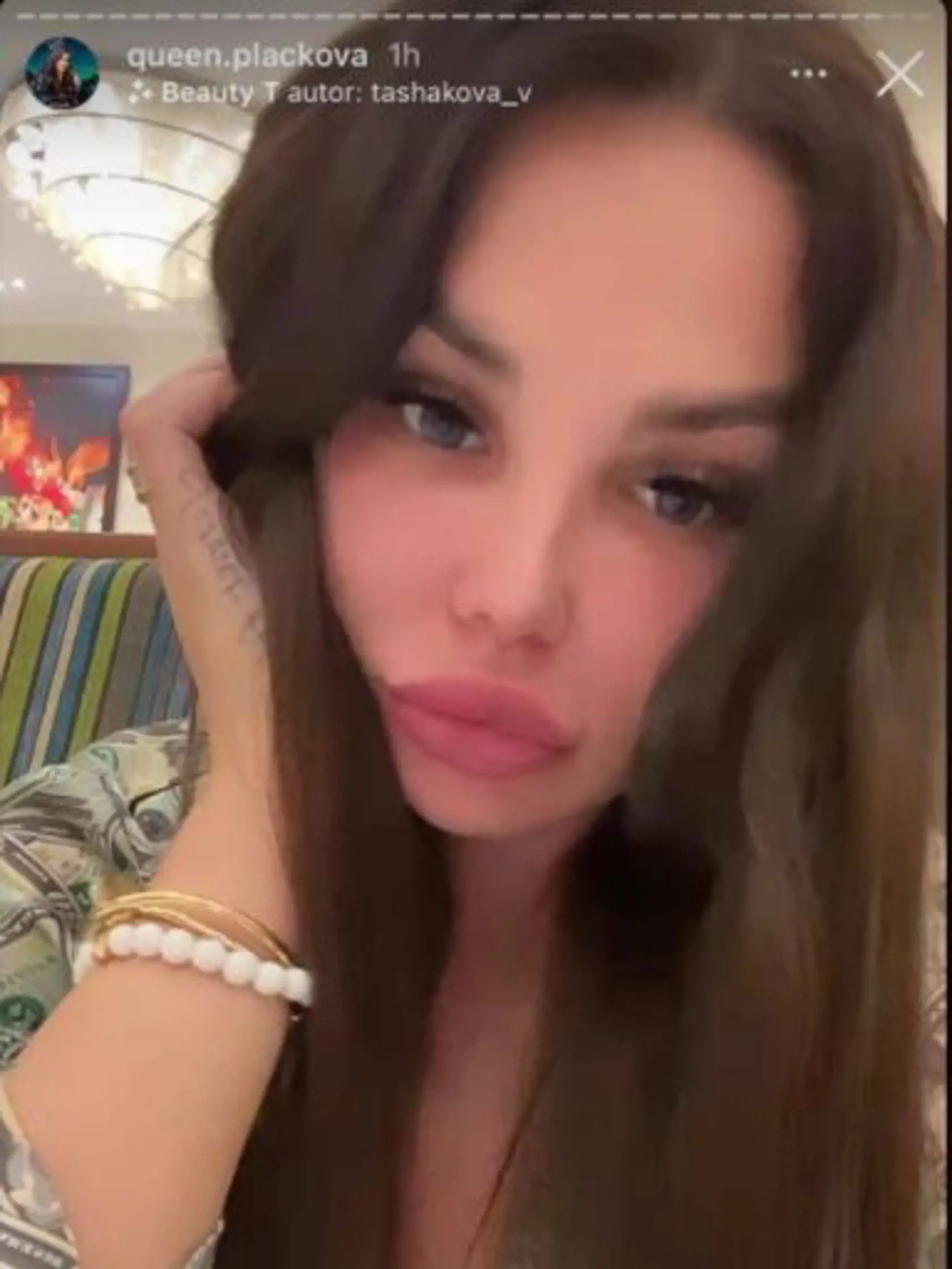 Aj keď za plastiku tváre vysolila 33-tisíc eur, Plačková musí neustále používať skrášľovacie filtre.