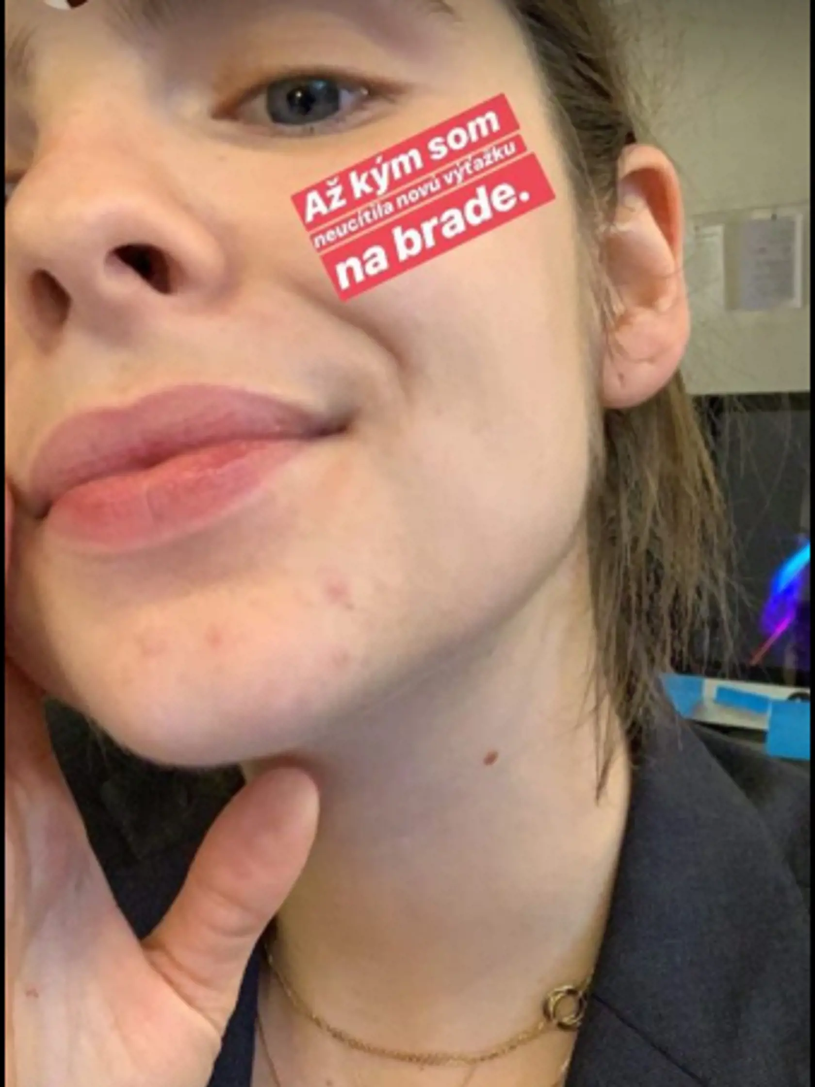 Brunetka sa verejne pochválila vyrážkou.