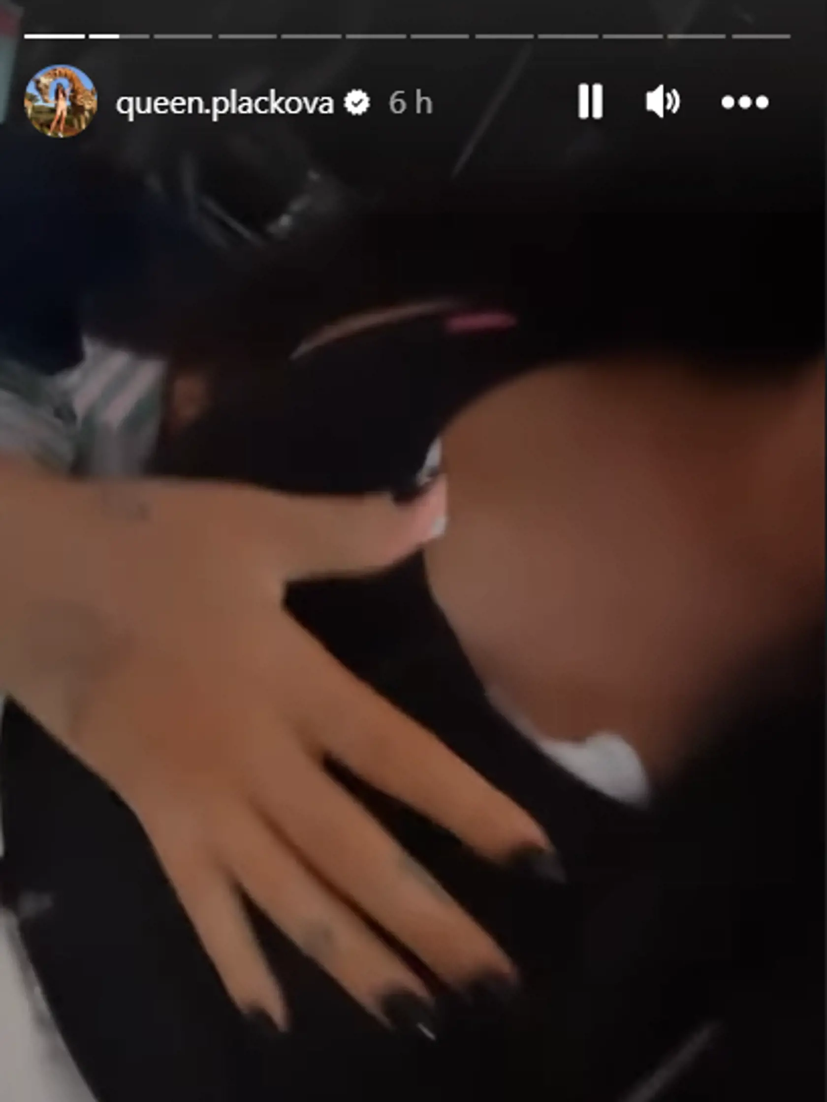 Zuzana Plačková si nechala zmenšiť prsia. Teraz má silikóny vo veľkosti 325 ml. Takto sa prihovorila influencerka svojim fanúšikom krátko po operácii už z pohodlia domova.