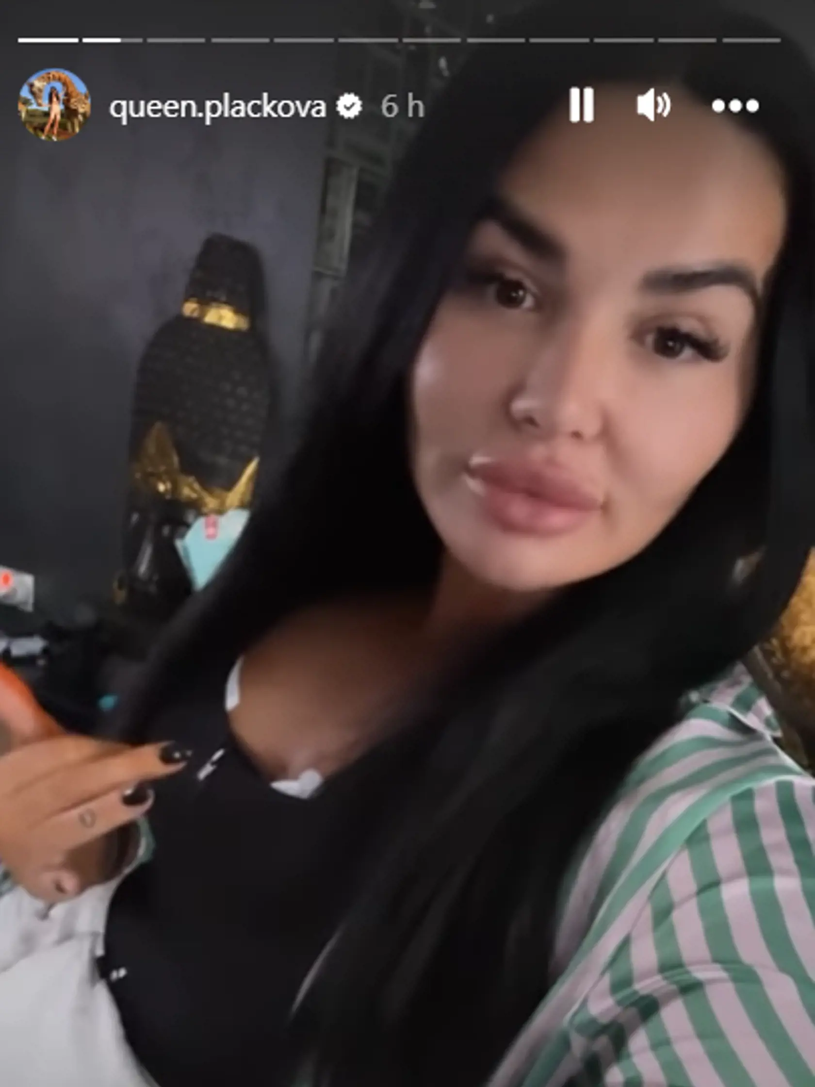Zuzana Plačková si nechala zmenšiť prsia. Teraz má silikóny vo veľkosti 325 ml. Takto sa prihovorila influencerka svojim fanúšikom krátko po operácii už z pohodlia domova.