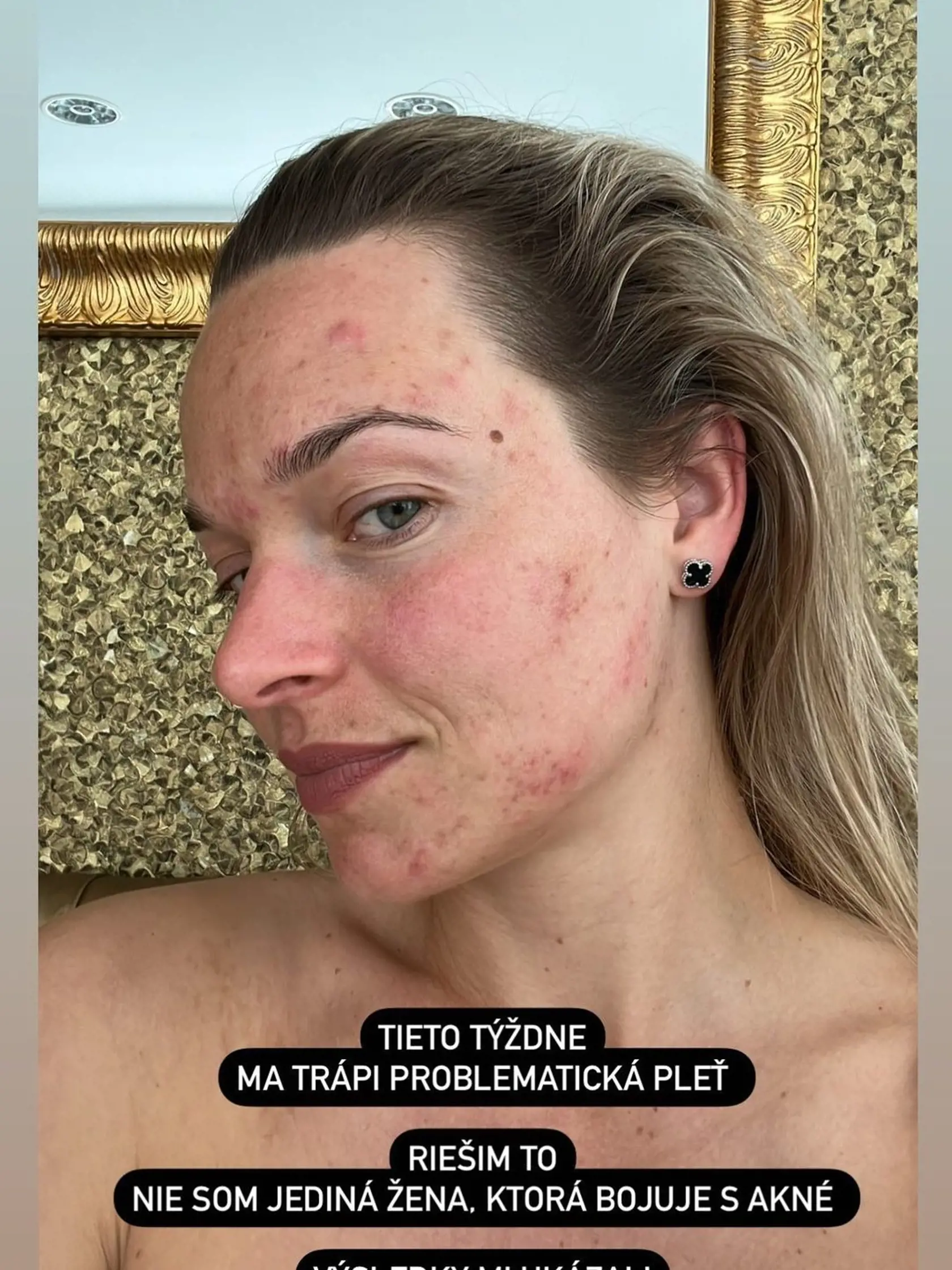 „Tieto týždne ma trápi problematická pleť. Výsledky mi ukázali, že som vysoko alergická na cesnak, papriku a mlieko,” pripísala Tabák k fotke, kde ju vidno so začervenanou tvárou a vyrážkami. Plánuje ísť aj na ďalšie testy, keďže stav jej pleti sa zlepšuje len pomalým tempom.