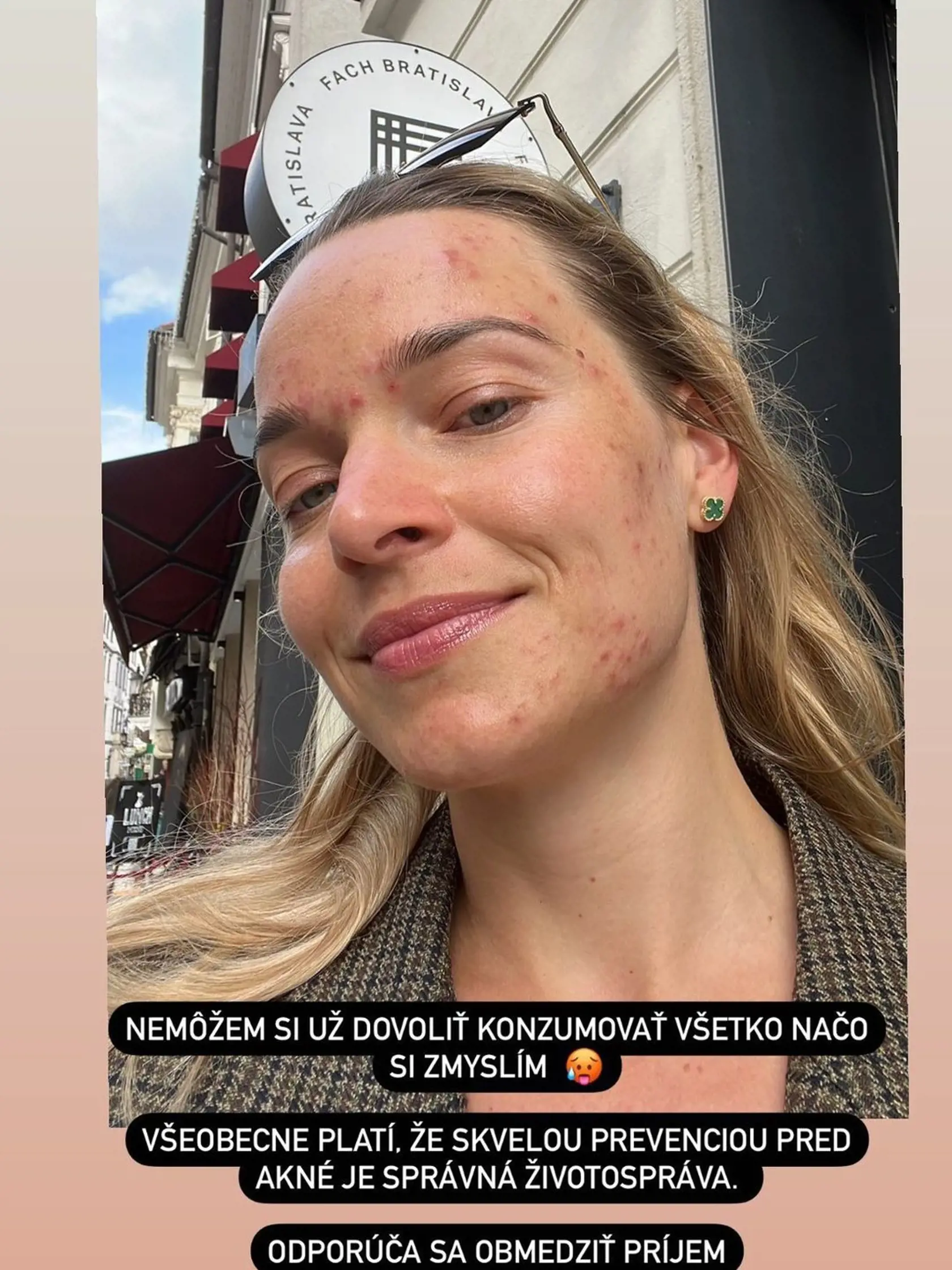 „Tento problém mám už pár týždňov. Myslím si, že moje telo prestalo tolerovať potraviny. Už som bola aj u lekára, zobrali mi krv a z výsledkov mi vyšlo, že som veľmi alergická na cesnak, papriku a mlieko. Ale aj keď som to vysadila, pozorujem, že som alergická aj na viacero iných potravín. Tým, že to neustupuje, tak to idem ďalej riešiť s doktormi, lebo ma to trápi,” zdôverila sa poslankyňa pre Plus JEDEN DEŇ.
