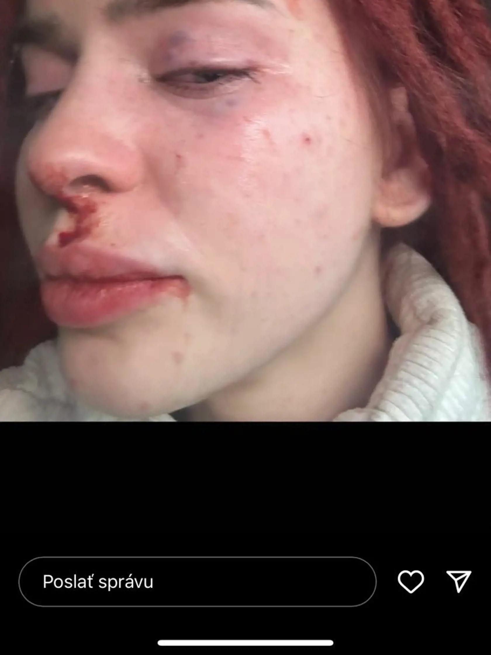 Rachel po bitke od priateľa