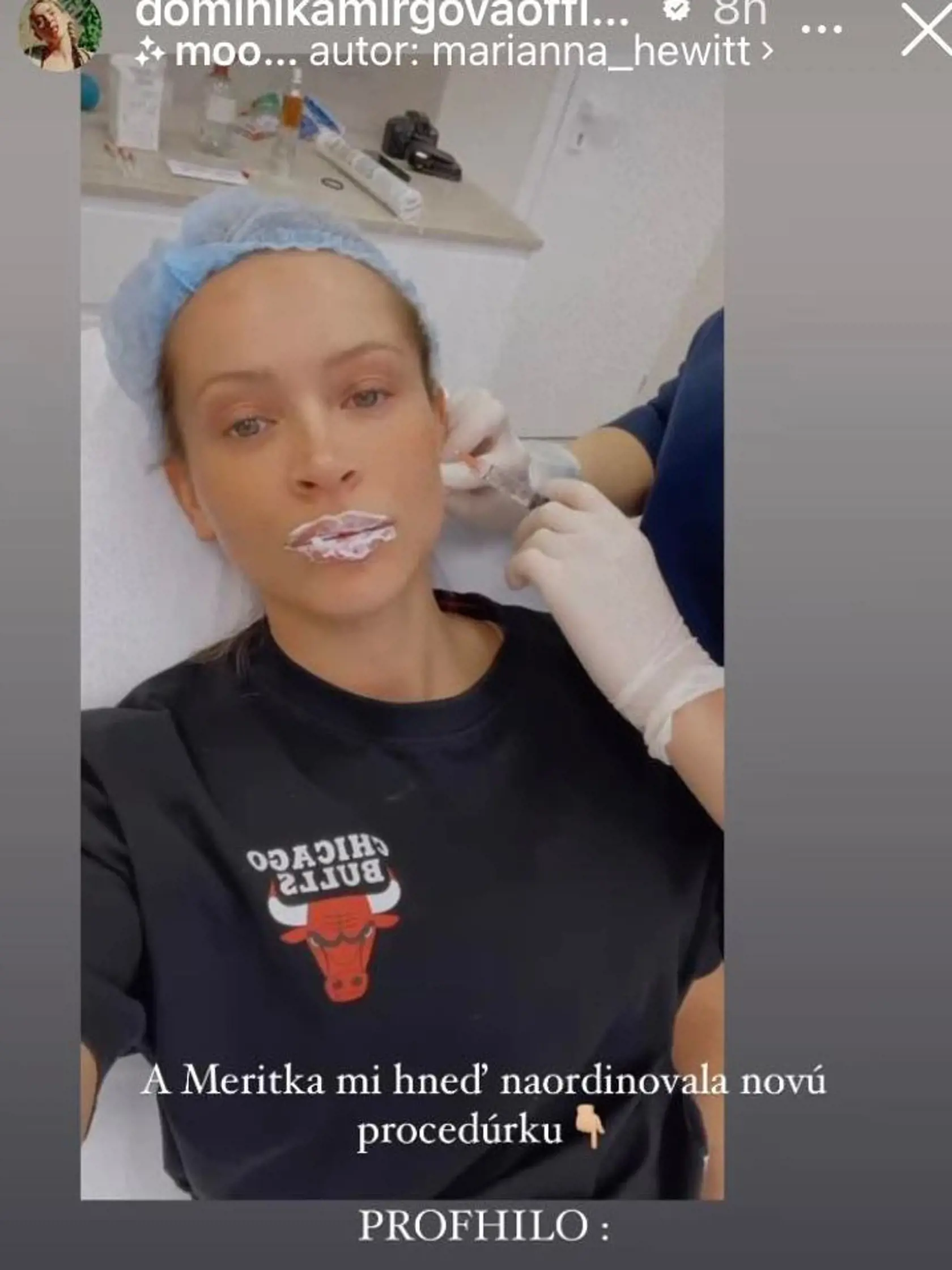 Dominika Mirgová konečne prezradila, čo všetko si dáva na sebe vylepšovať - pery, dáva si botox + hydratáciu pleti. A dokonca si dala pozdvihnúť oko.