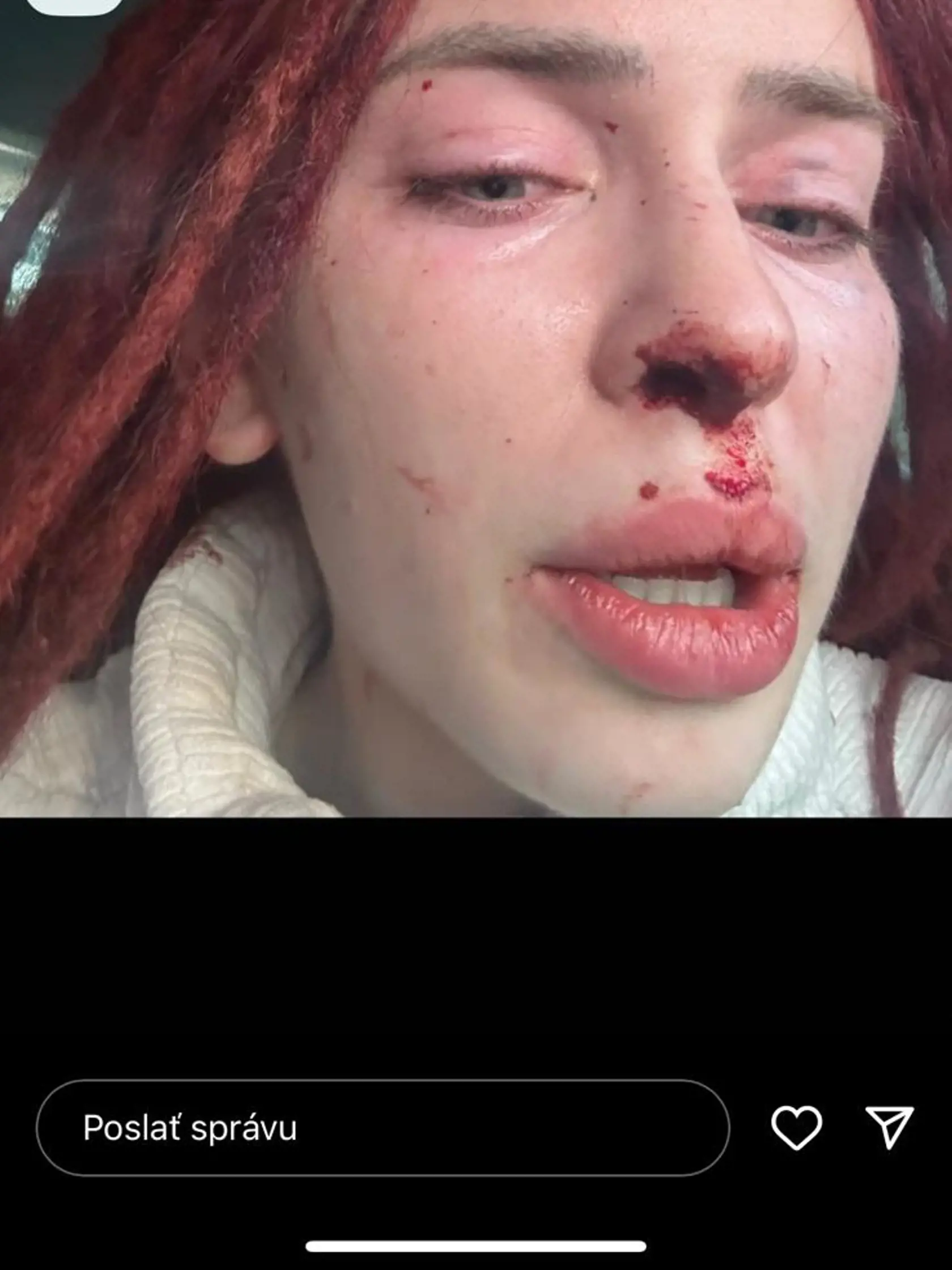 Ráchel po tom, čo ju jej priateľ Kotty napadol.