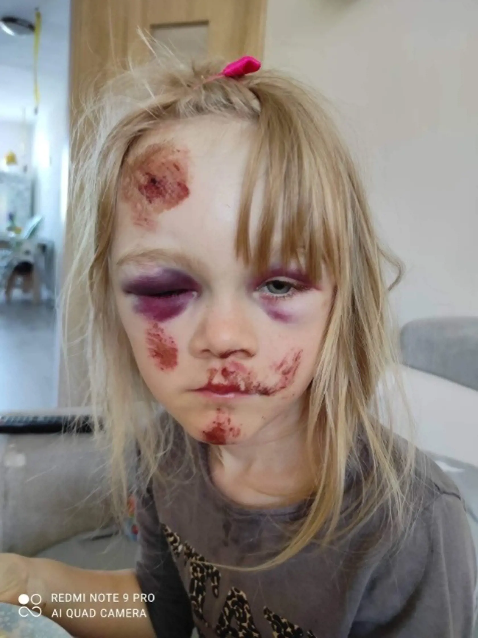 Nelinka  (7)  je po páde doudieraná najmä na tvári. Udreté má aj rebrá. Namiesto užívania si prázdnin, dievčatko musí byť doma a v kľude. Otec podpísal reverz a zobral ju z nemocnice do domáceho liečenia.