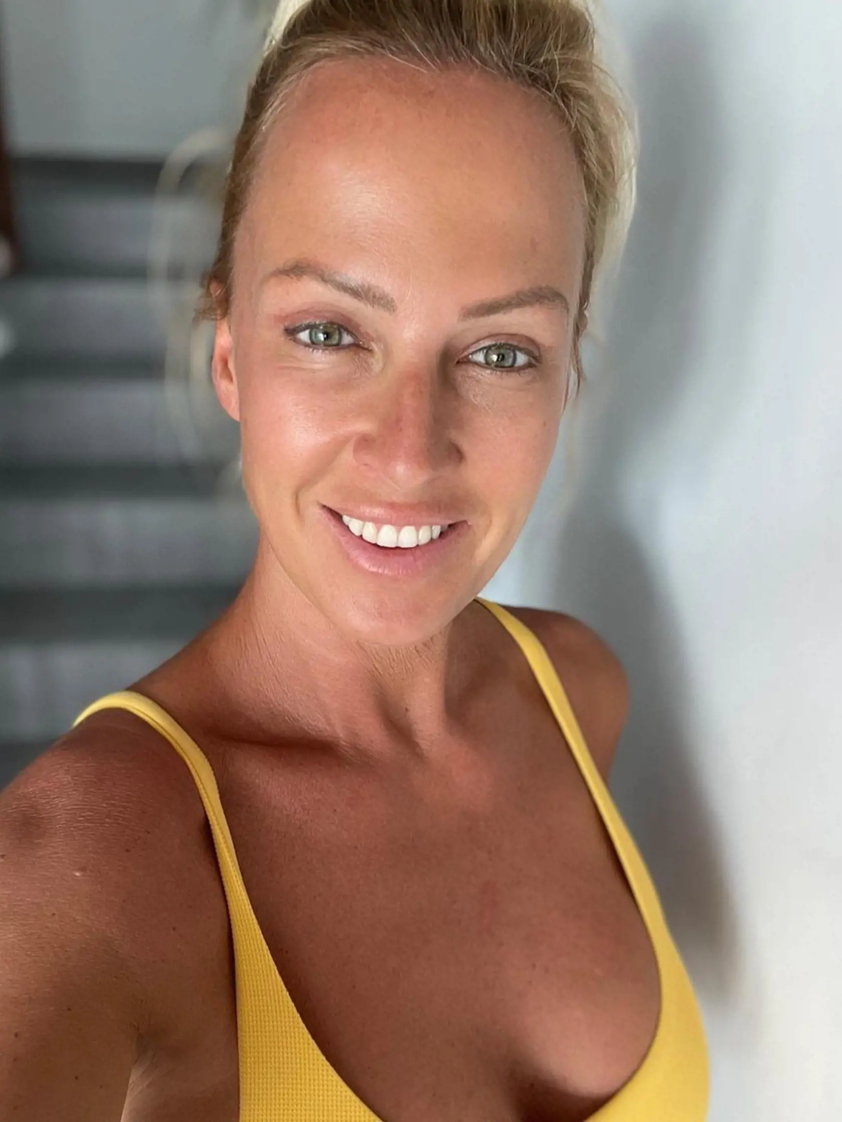 Zuzka Belohorcová po plastike.