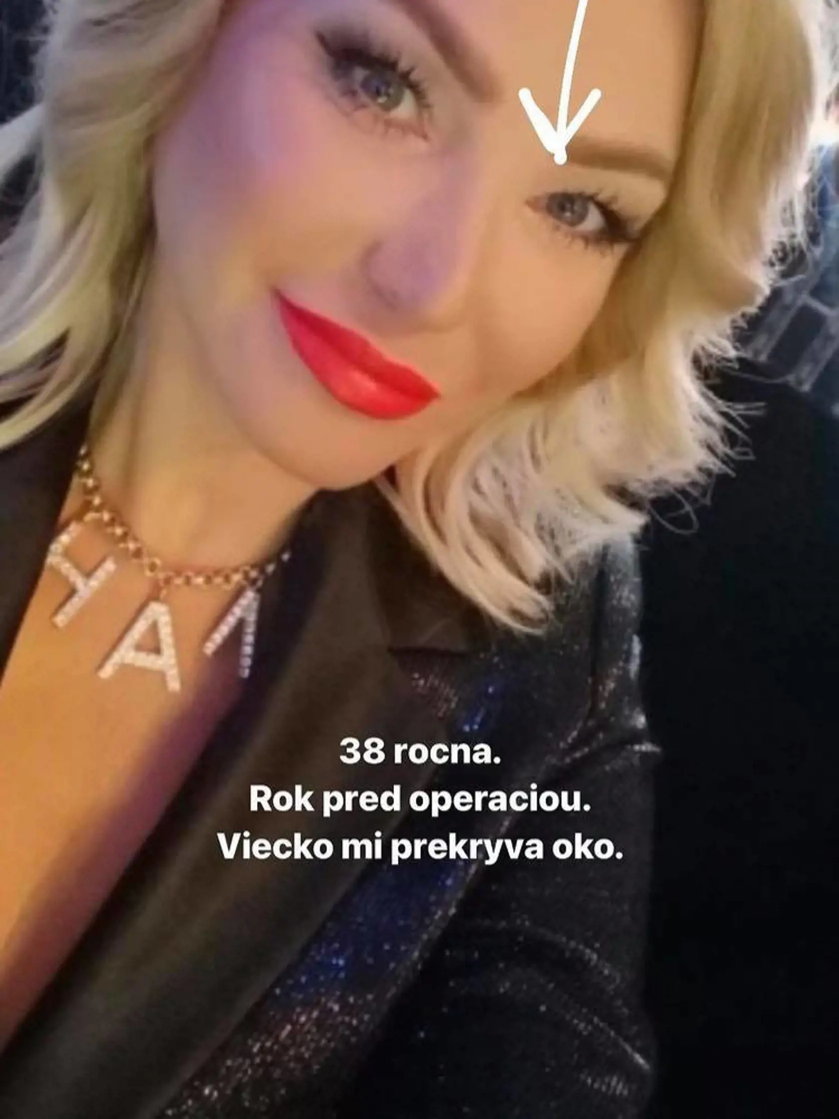 Pallová prezradila, že ako 39-ročná absolvovala operáciu viečok.
