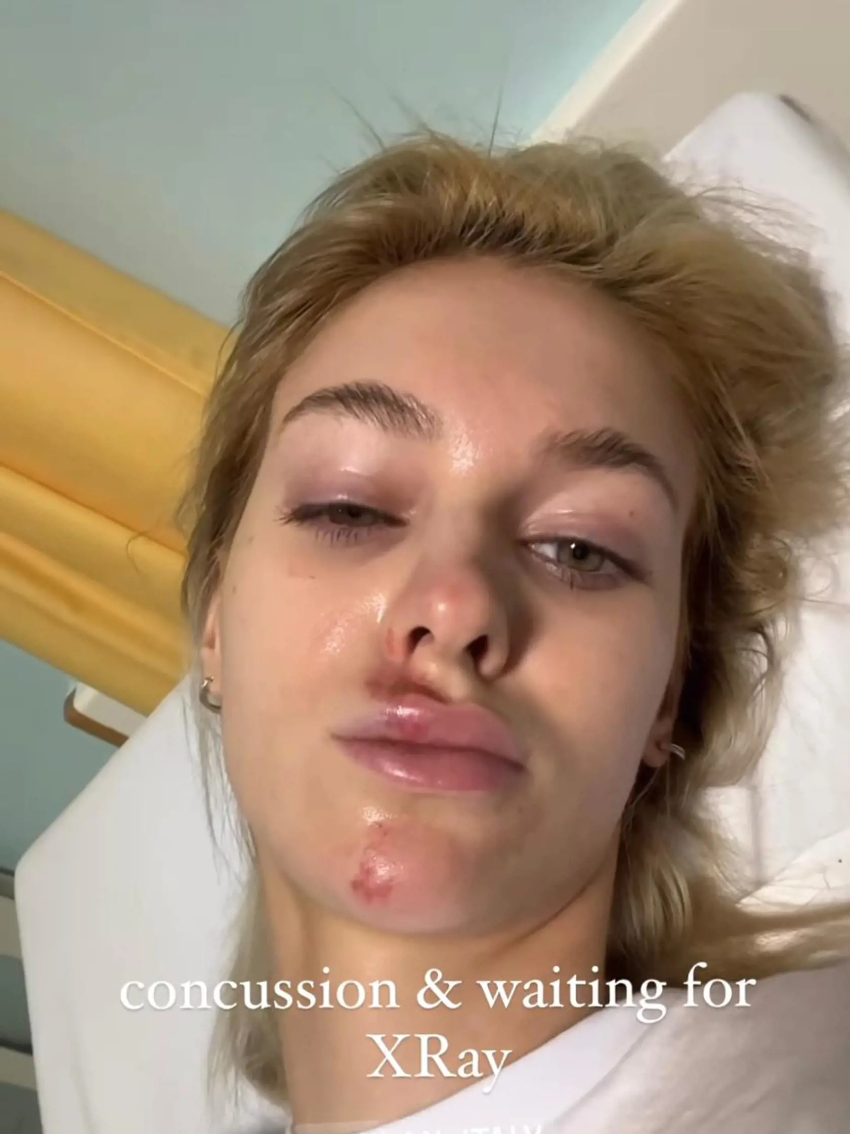 Veronika Rajek sa nedávno zranila na kolobežke.