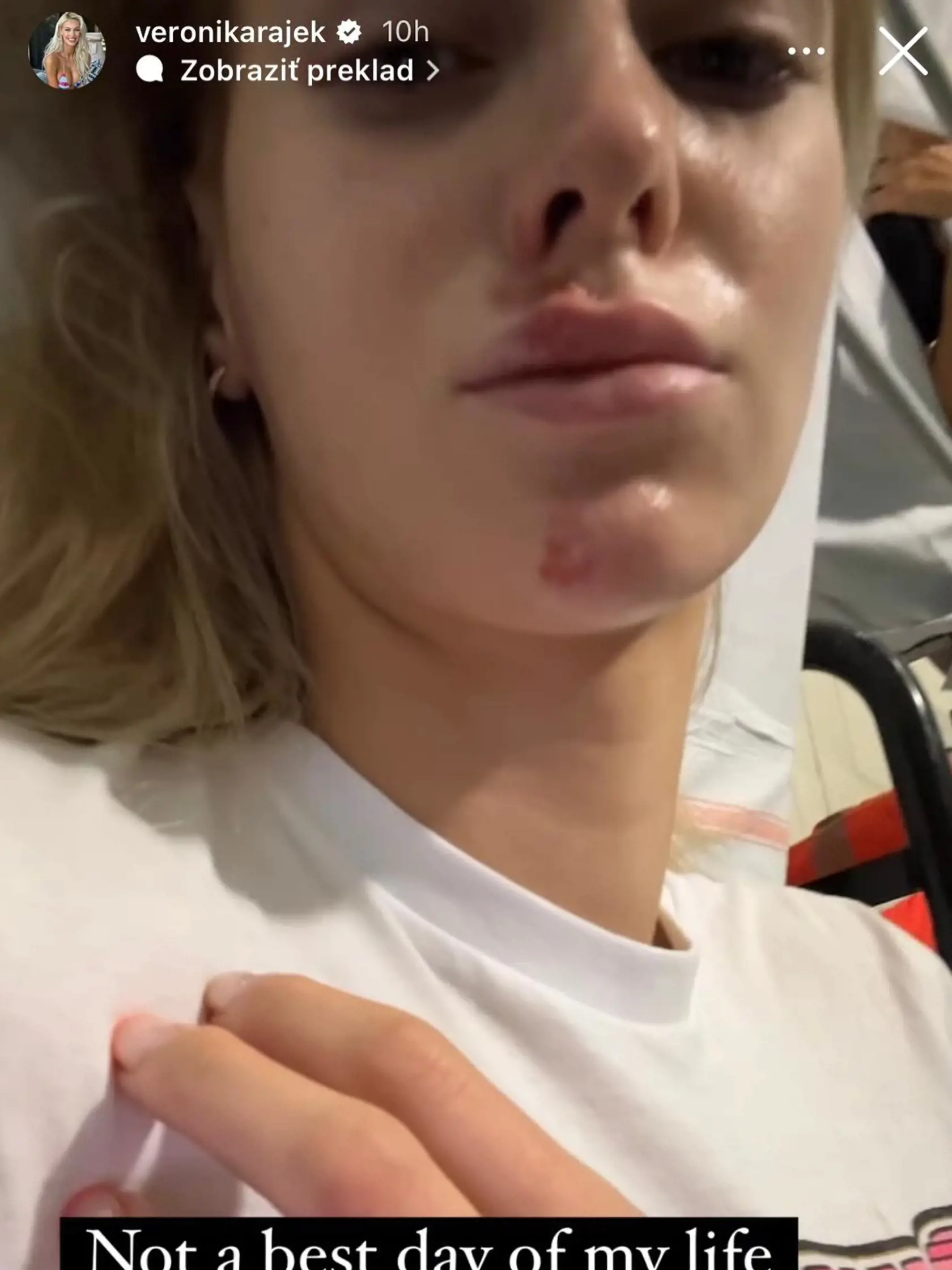 Veronika Rajek sa nedávno zranila na kolobežke.