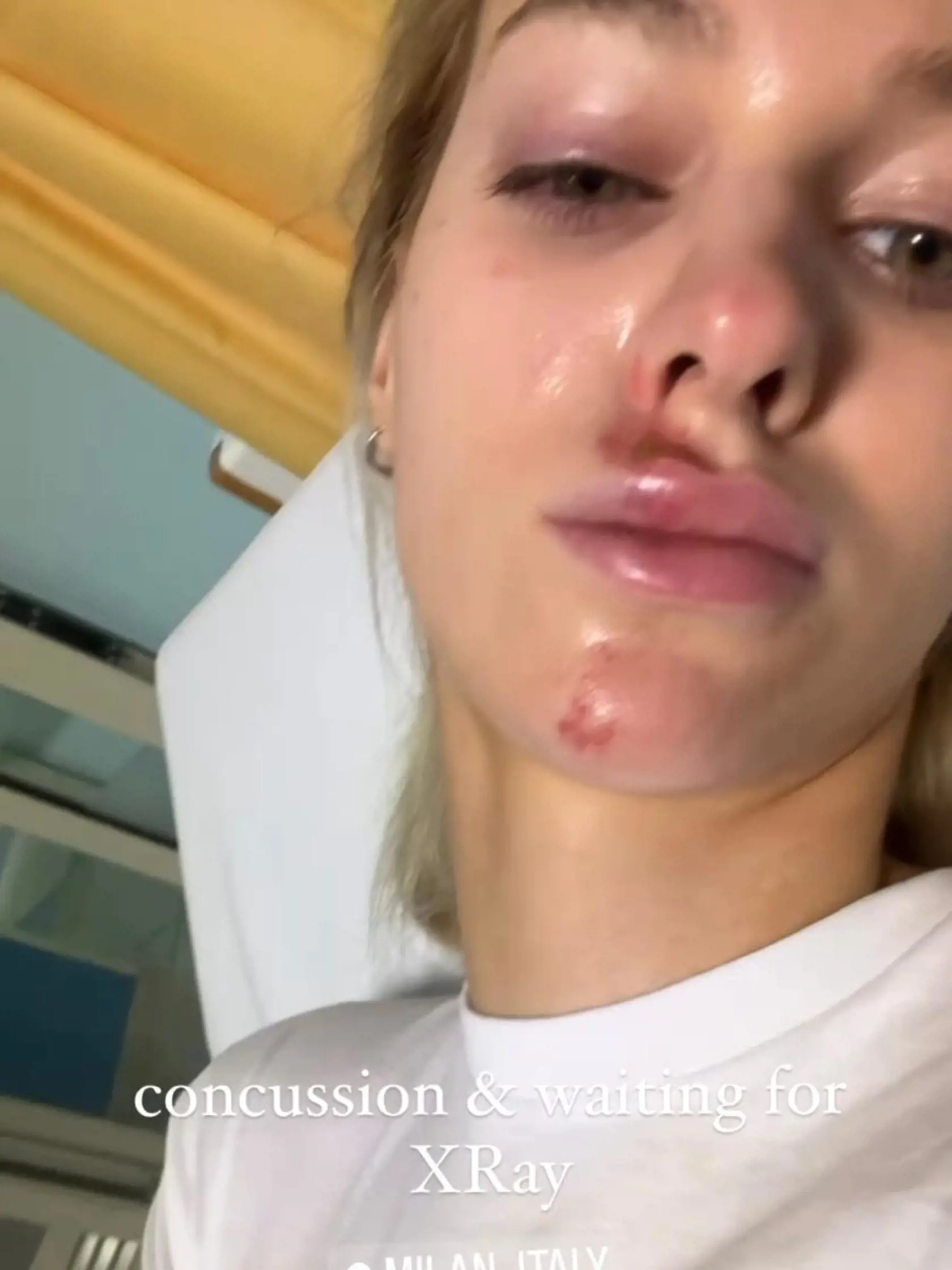 Veronika Rajek sa nedávno zranila na kolobežke.
