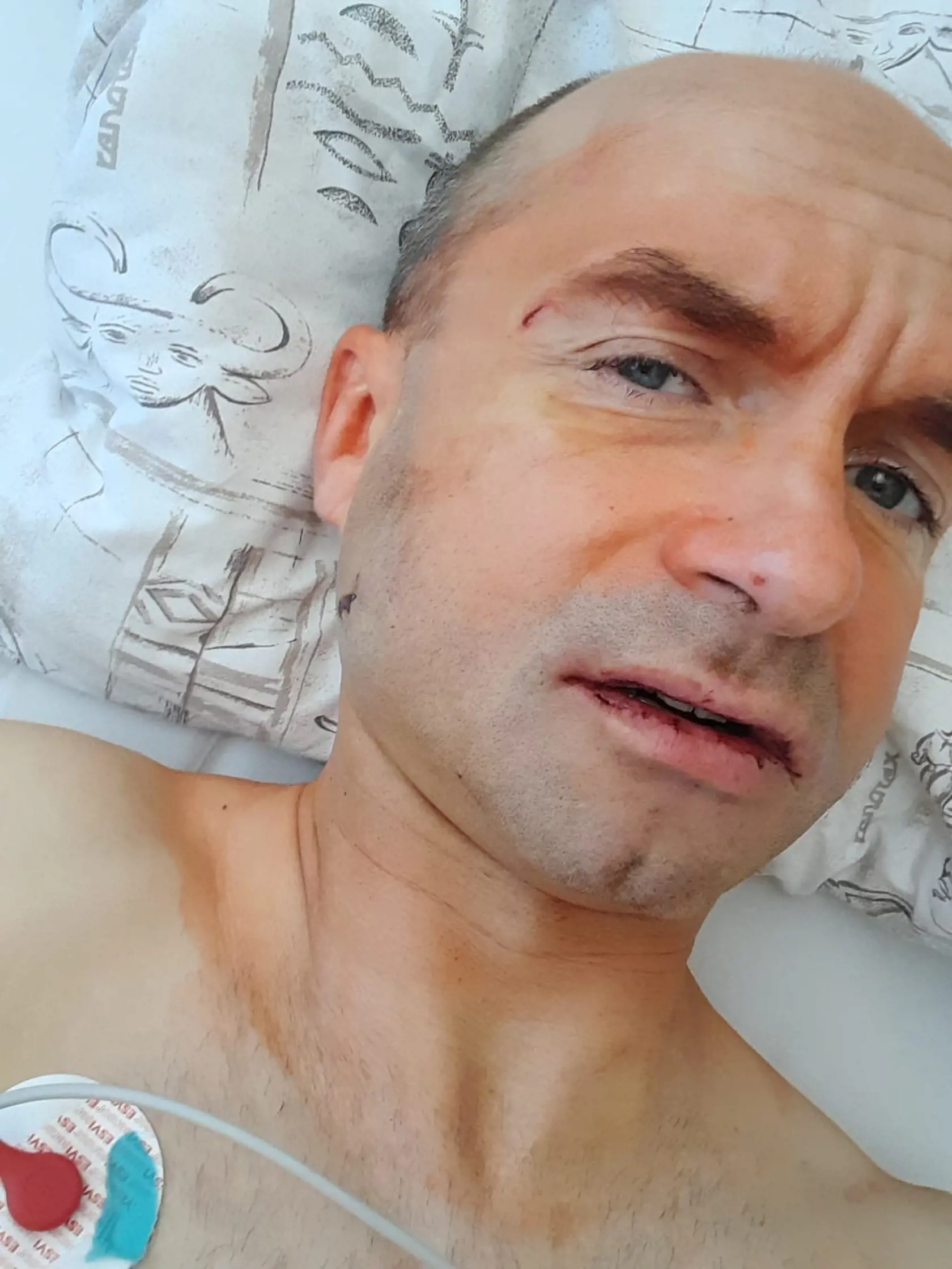 Rapera Meca Vrabca surovo zbili na Obchodnej ulici v Bratislave. Skončil v nemocnici s trojitou zlomeninou sánky.