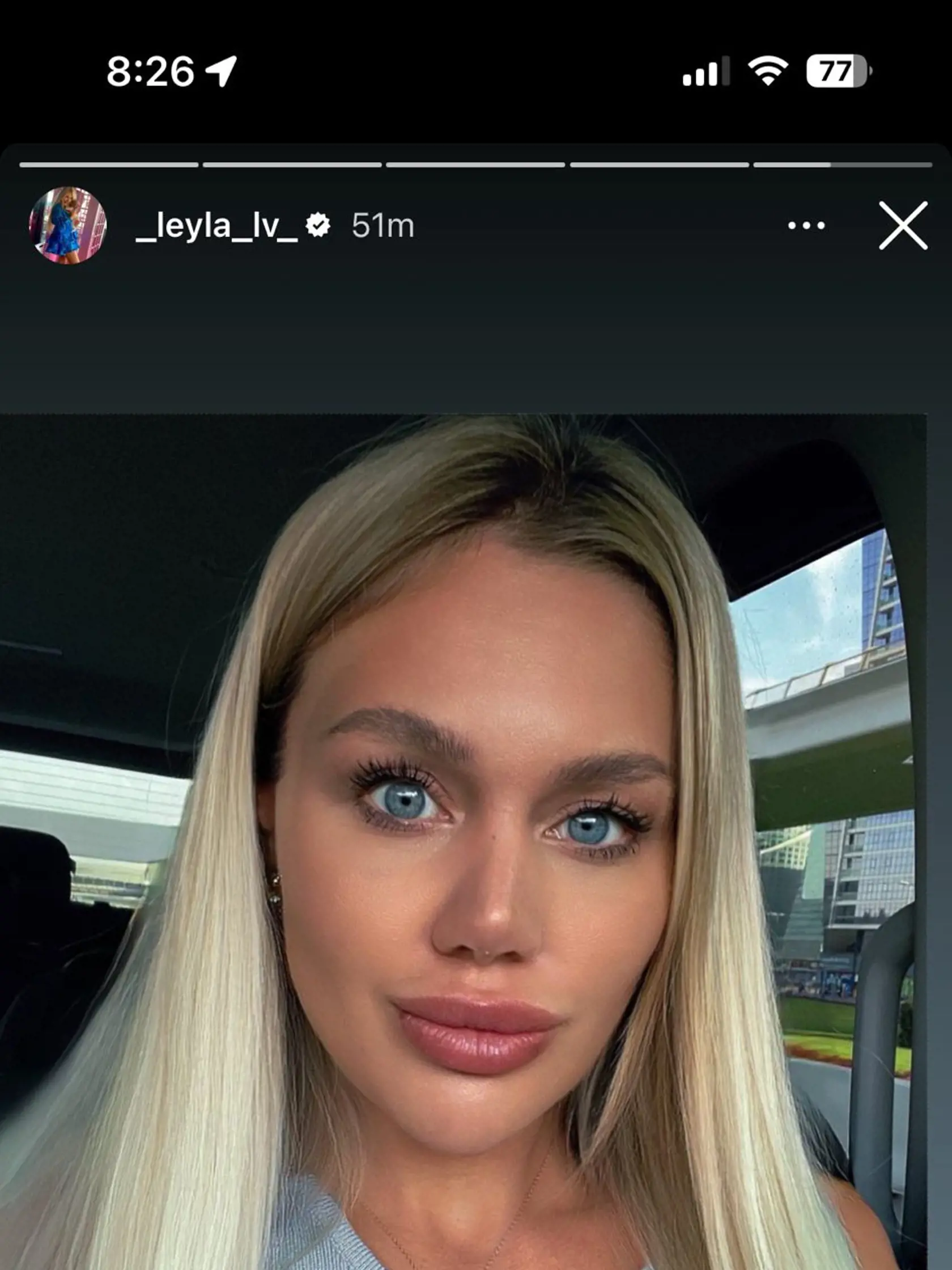 Laura po plastickej operácii nosu