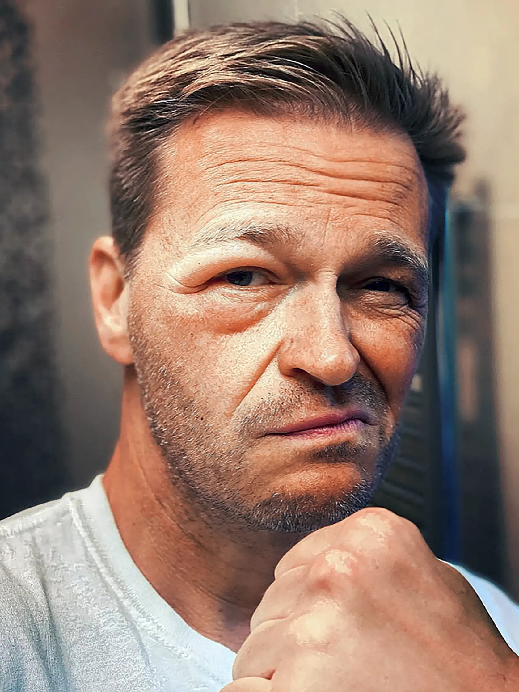 Martin Nikodým po útoku včelou.
