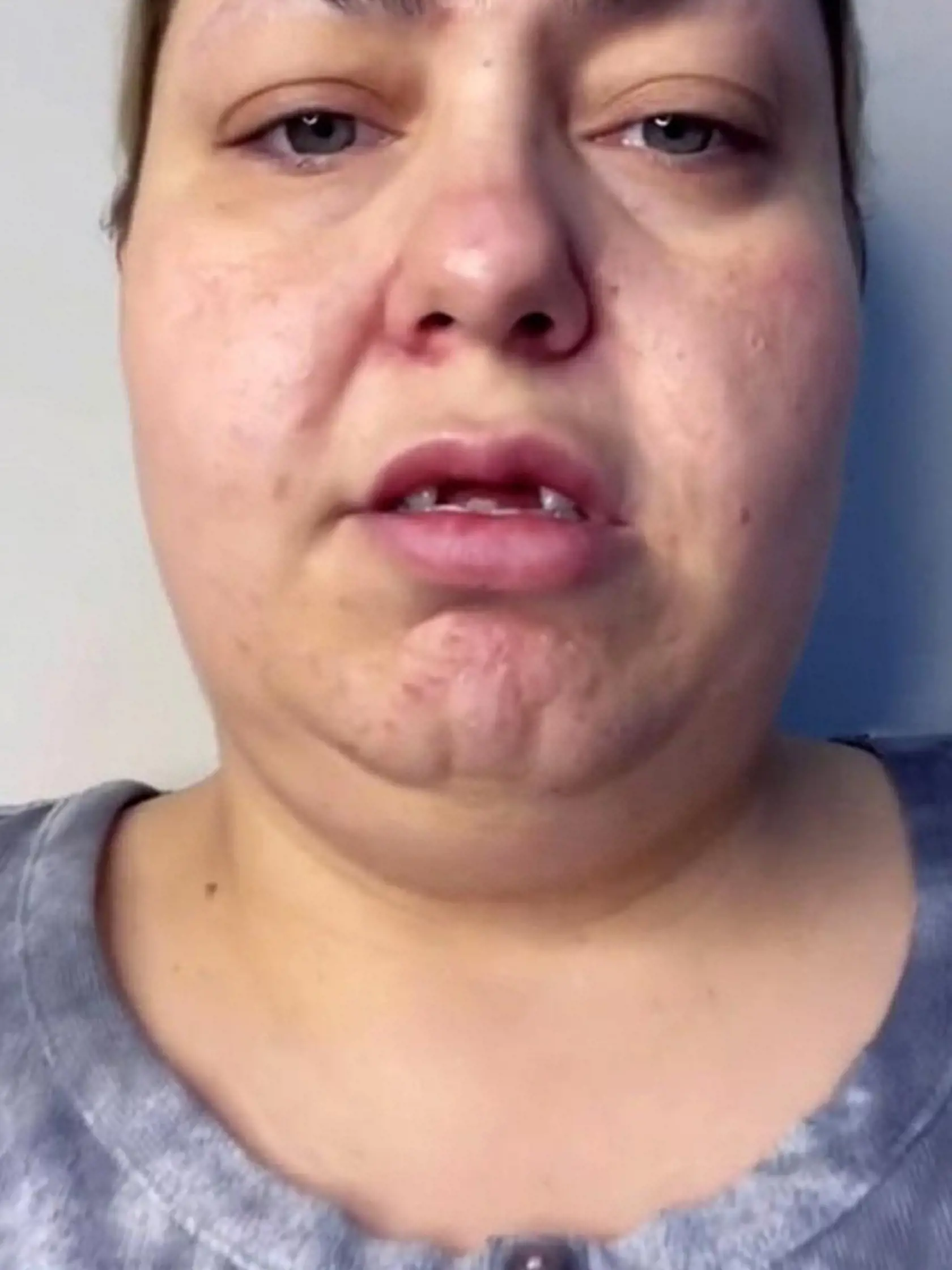 Sarah pre svoj vzhľad neraz stretla so šikanou, ktorá jej veľmi ubližovala. Dnes svoju tvár ukazuje celému svetu a fandí jej mnoho ľudí.