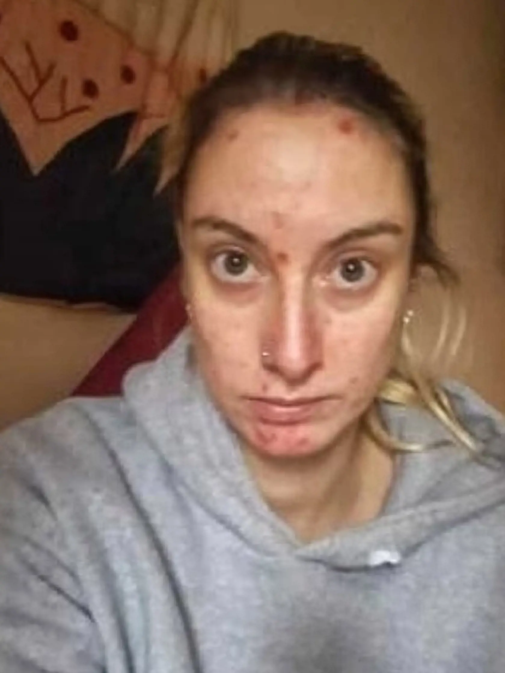 Závislosť na alkohole si vyžiadala svoju daň. Abi mala zdravotné ťažkosti, depresie a na tvári mala vyrážky.