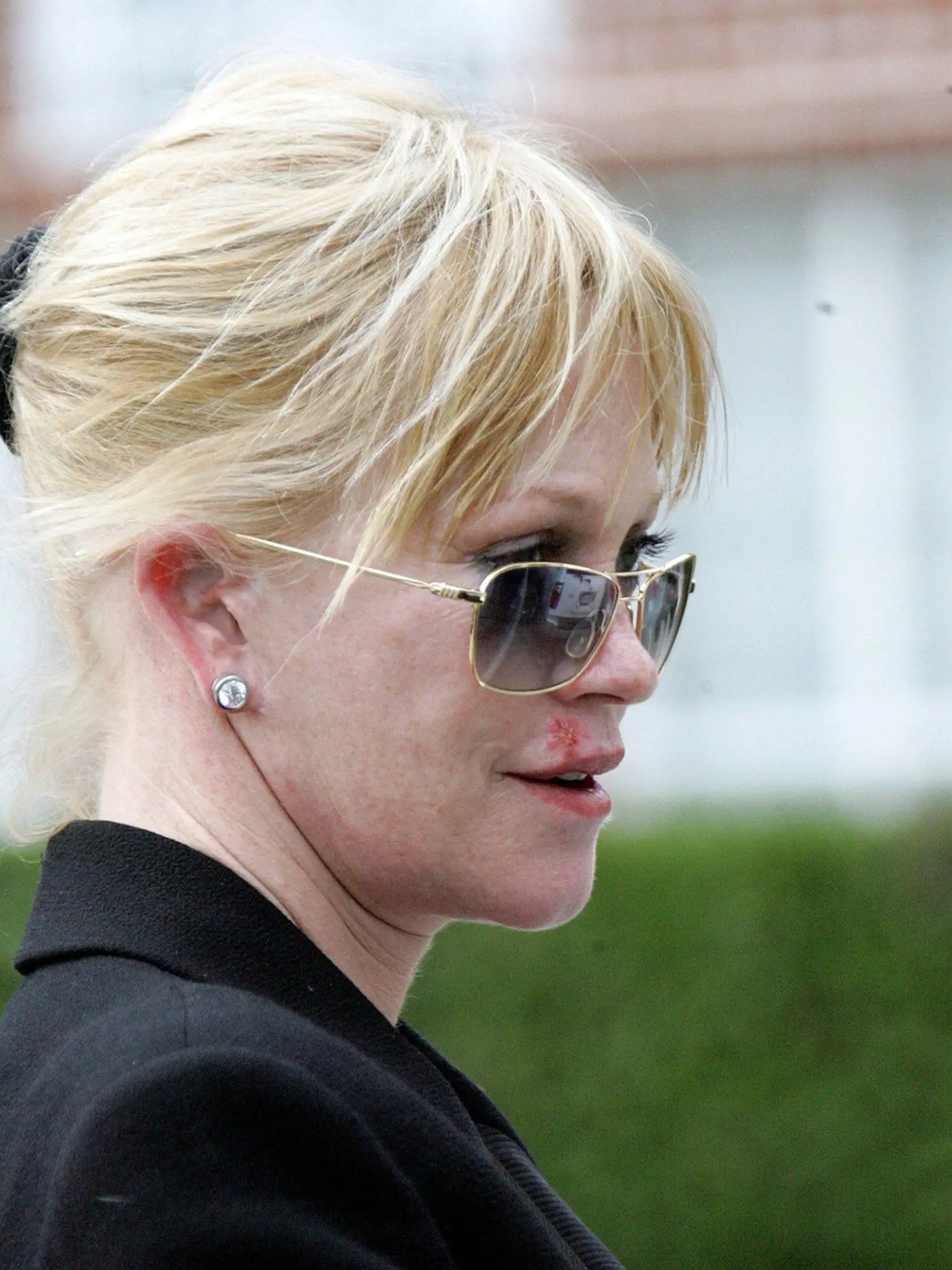 Melanie Griffith. Aj keď dala okuliare, herpes neskryla.